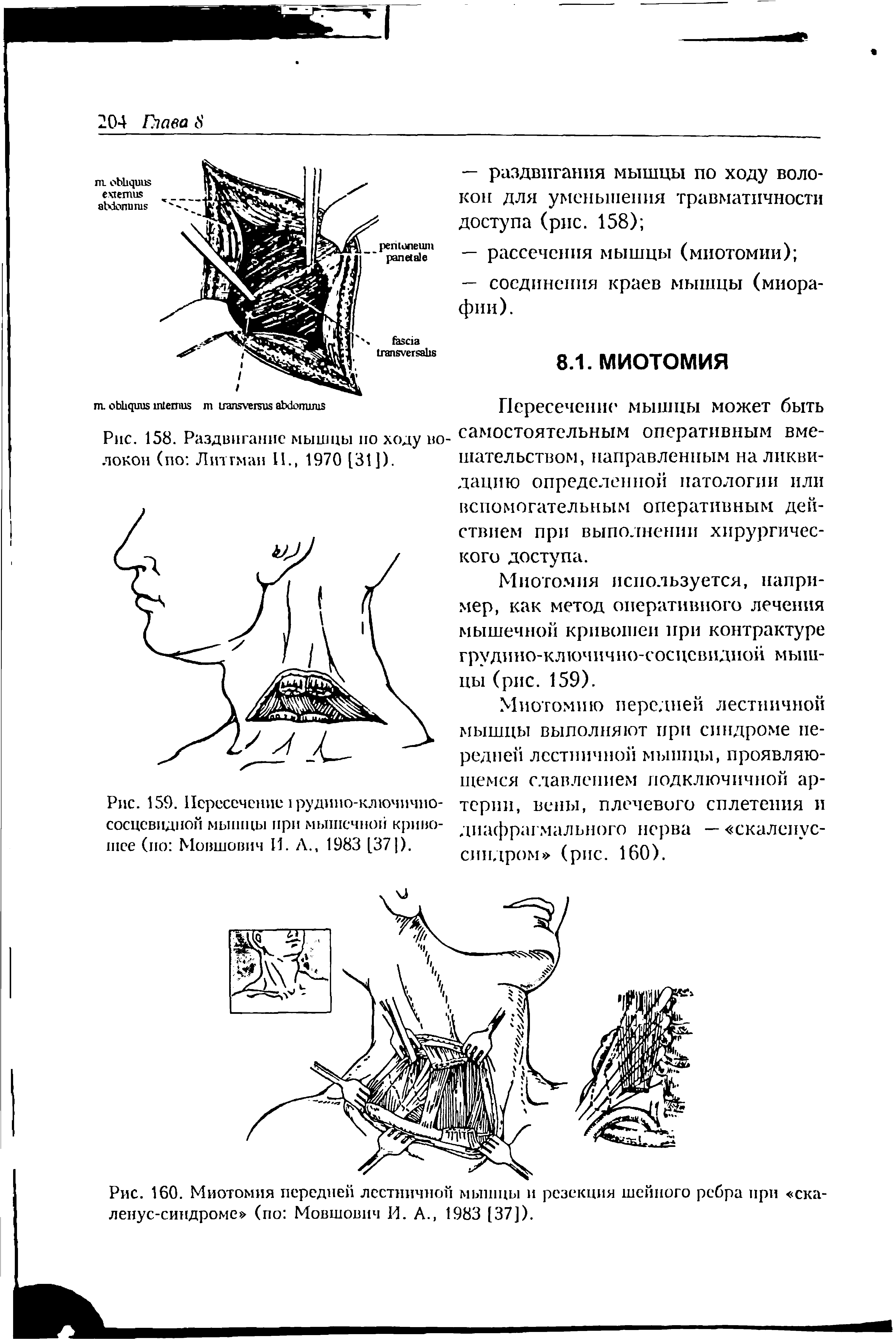 Рис. 160. Миотомия передней лестничной мышцы и резекция шейного ребра при ска-ленус-синдроме (по Мовшович И. А., 1983 [37]).