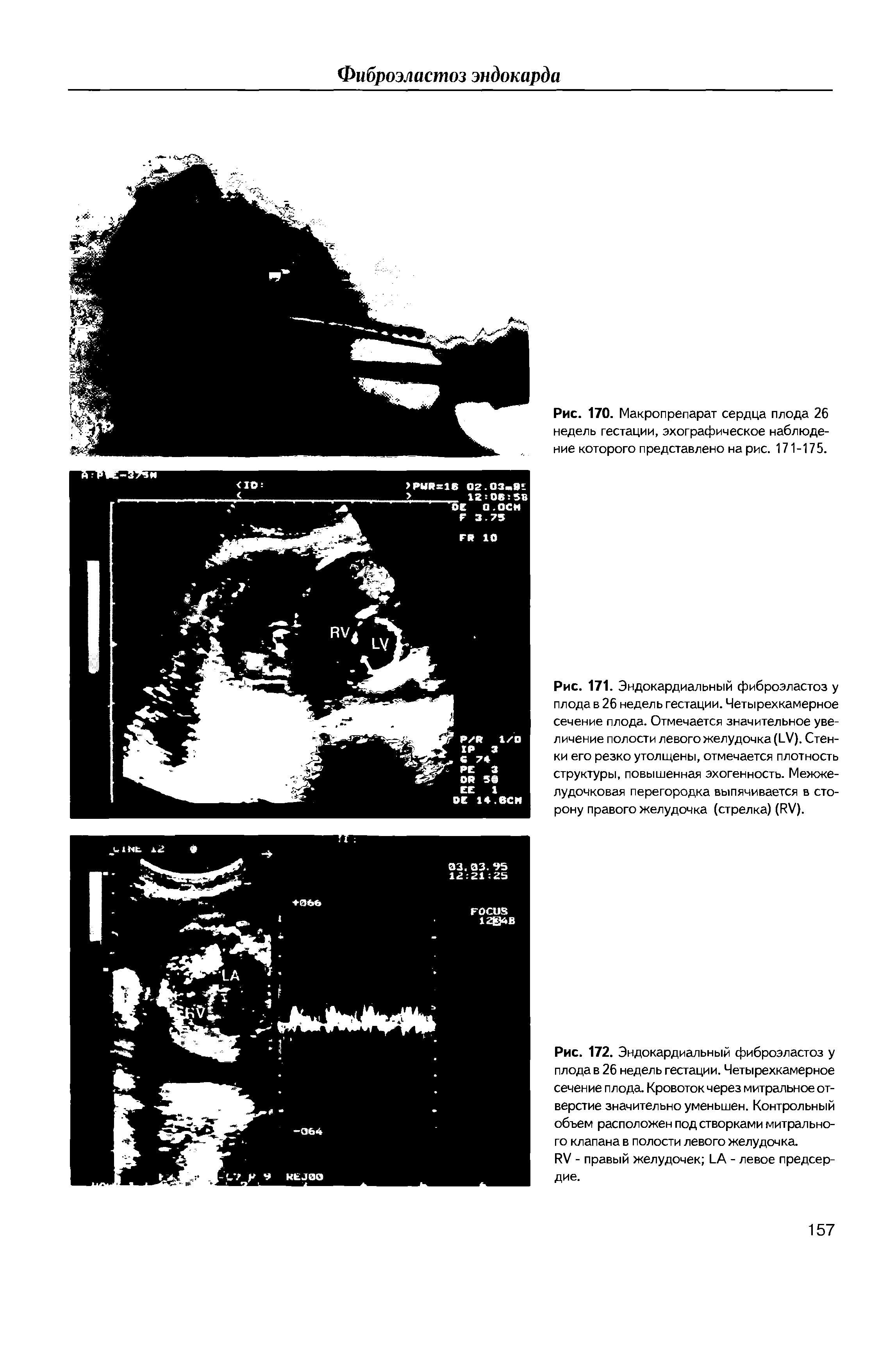 Рис. 171. Эндокардиальный фиброэластоз у плода в 26 недель гестации. Четырехкамерное сечение плода. Отмечается значительное увеличение полости левого желудочка (бУ). Стенки его резко утолщены, отмечается плотность структуры, повышенная эхогенность. Межжелудочковая перегородка выпячивается в сторону правого желудочка (стрелка) (КУ).