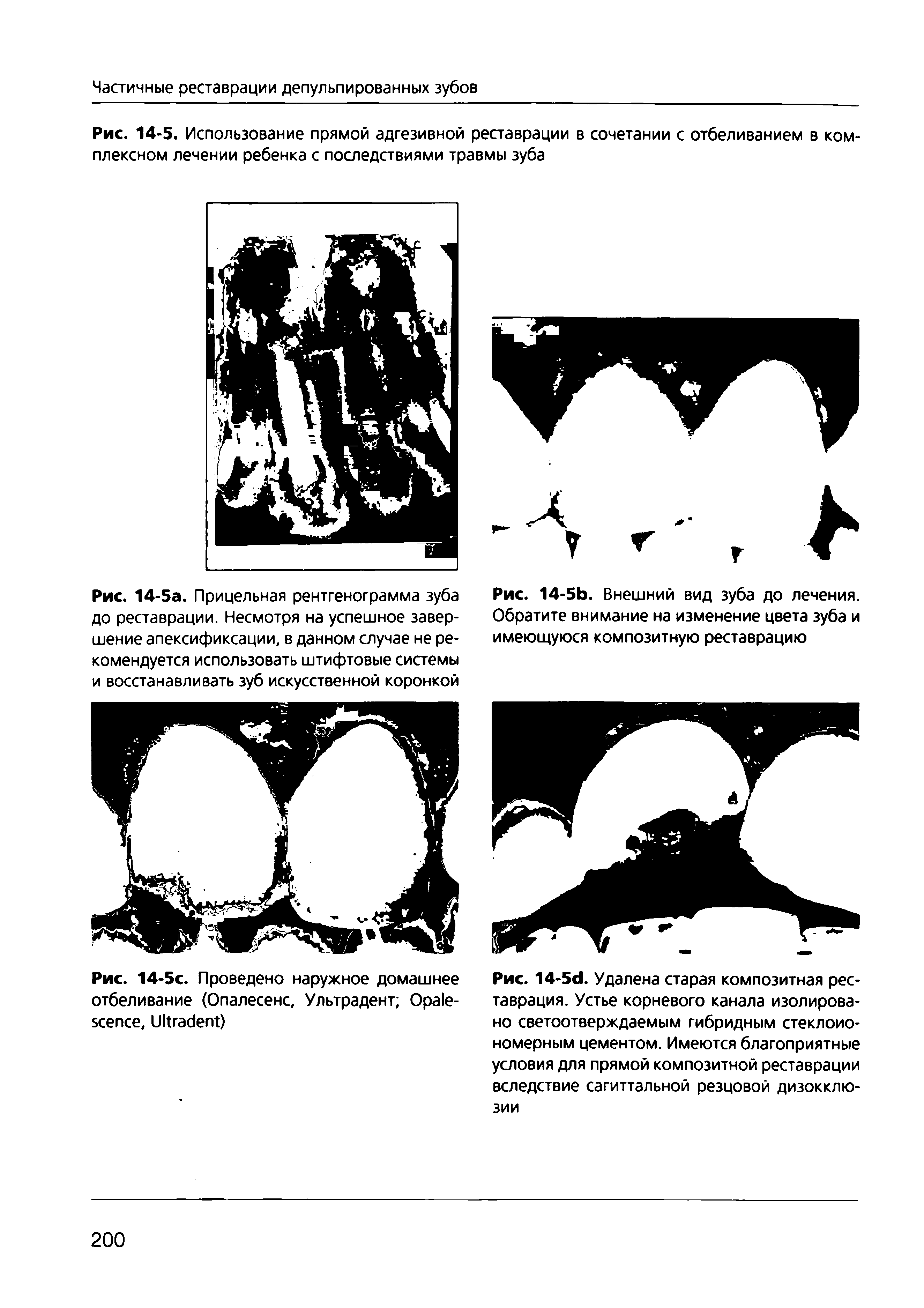 Рис. 14-5. Использование прямой адгезивной реставрации в сочетании с отбеливанием в комплексном лечении ребенка с последствиями травмы зуба...