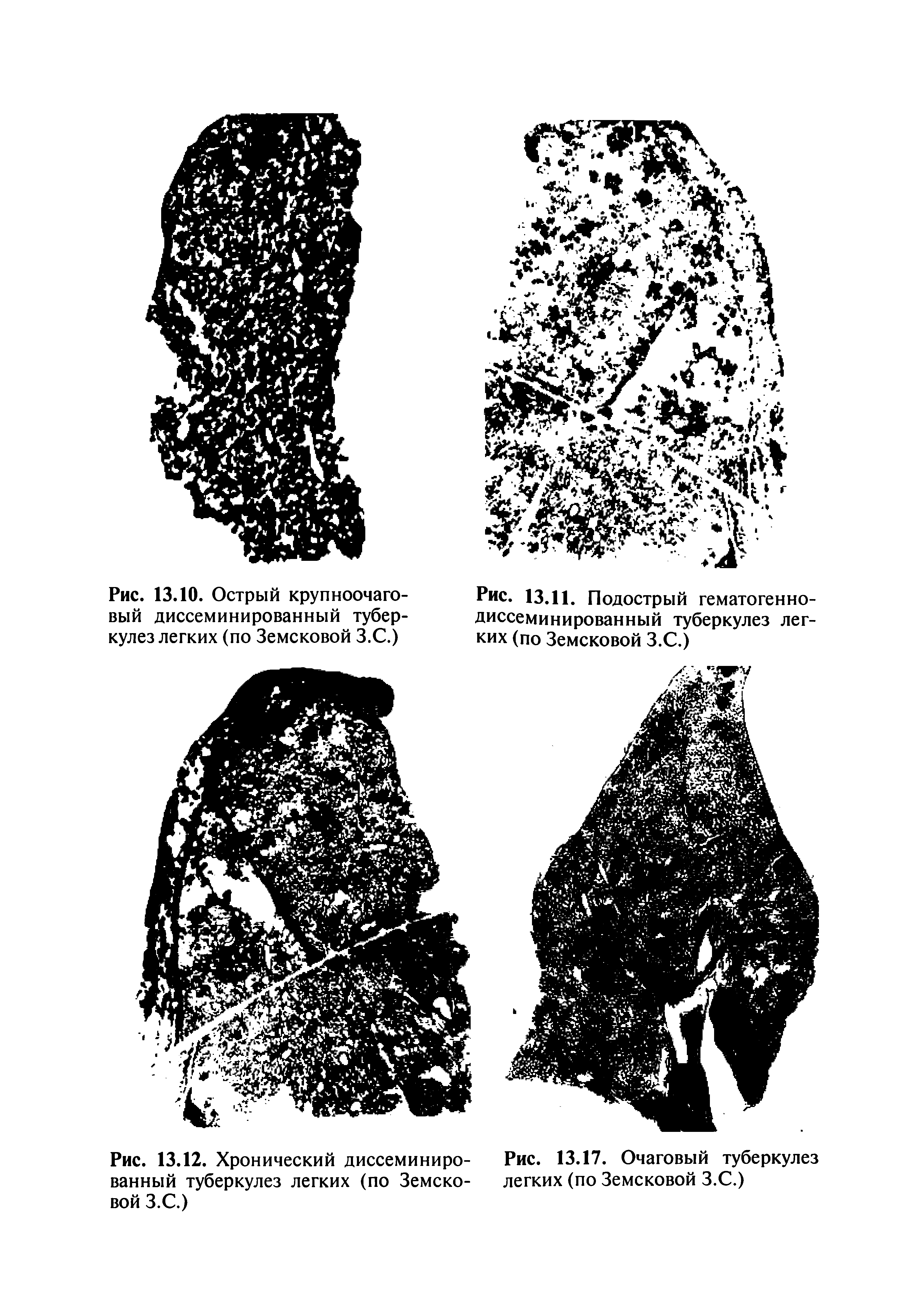 Рис. 13.12. Хронический диссеминиро- Рис. 13.17. Очаговый туберкулез ванный туберкулез легких (по Земско- легких (по Земсковой З.С.) вой З.С.)...
