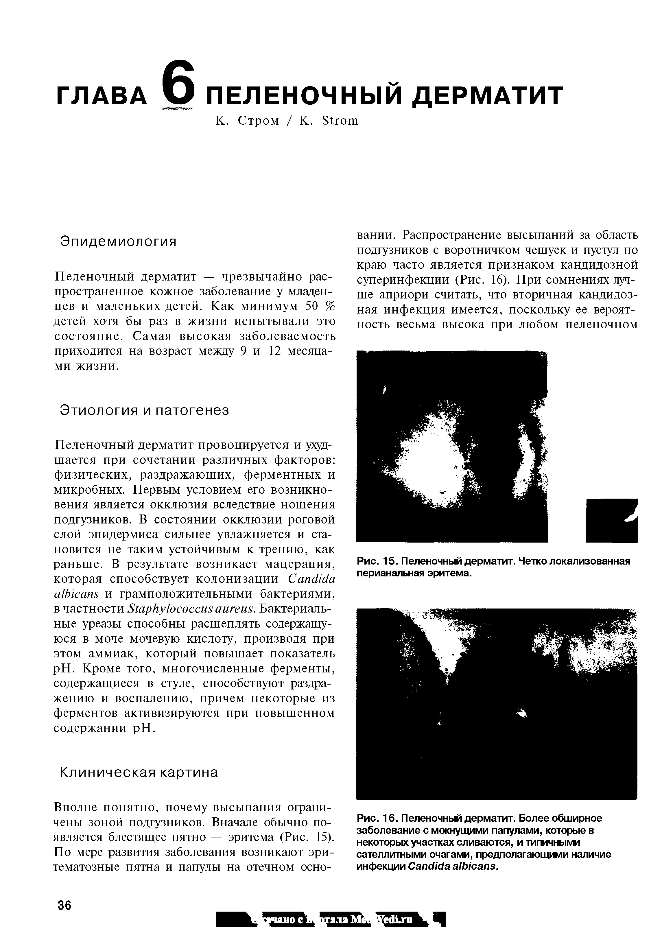 Рис. 15. Пеленочный дерматит. Четко локализованная перианальная эритема.