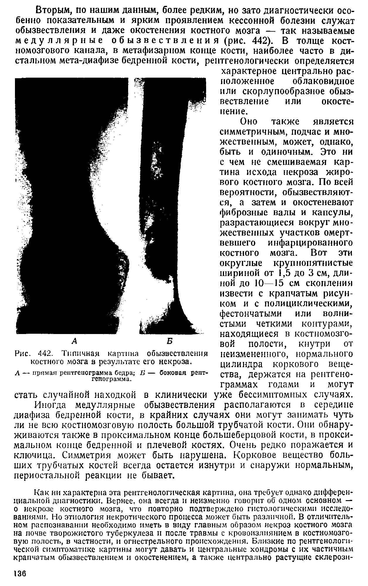 Рис. 442. Типичная картина обызвествления костного мозга в результате его некроза.