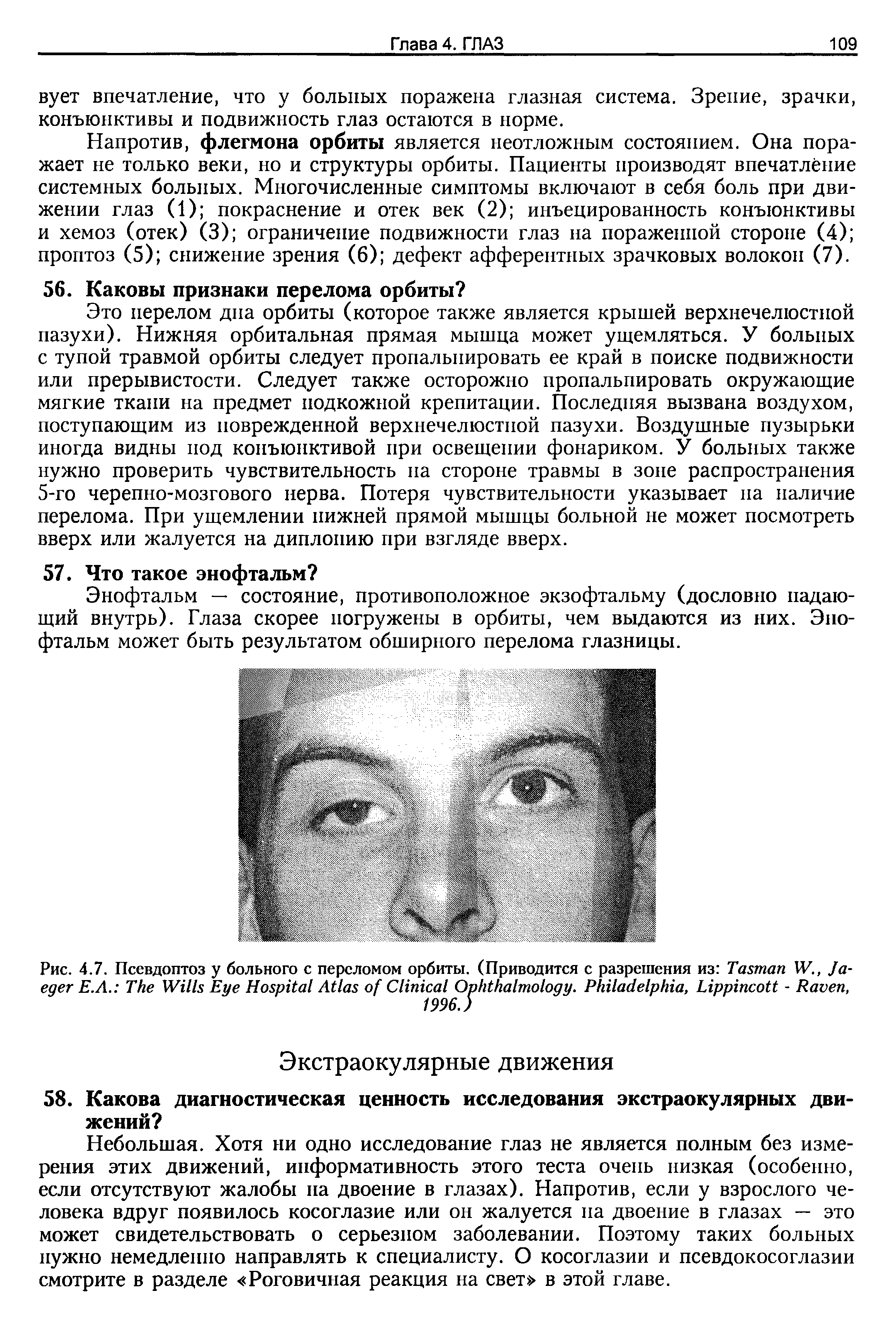 Рис. 4.7. Псевдоптоз у больного с переломом орбиты. (Приводится с разрешения из T W., J Е.Л. T W E H A C O . P , L - R , 1996.)...