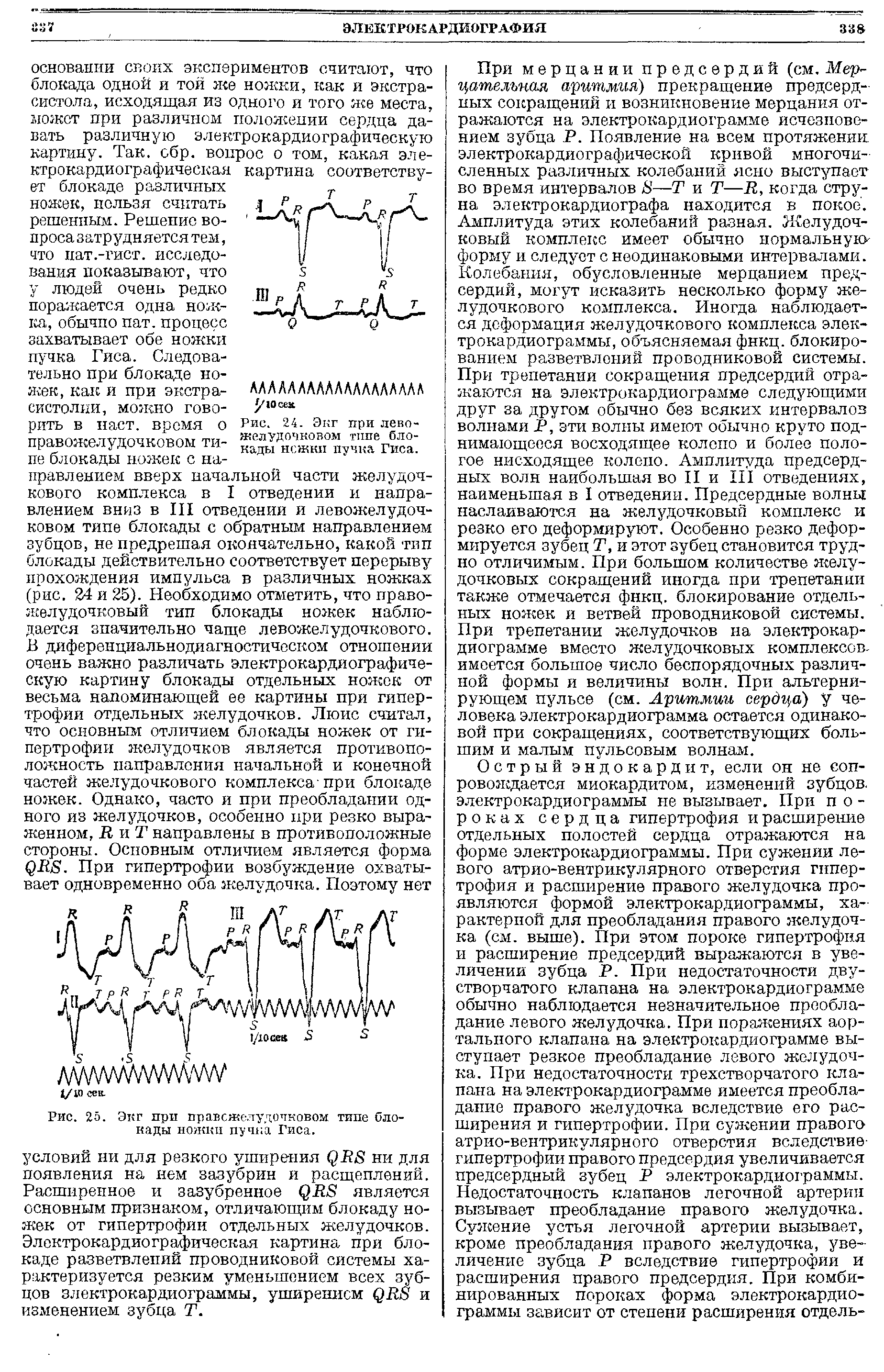 Рис. 24. Экг при левожелудочковом типе блокады ножки пучка Гиса.