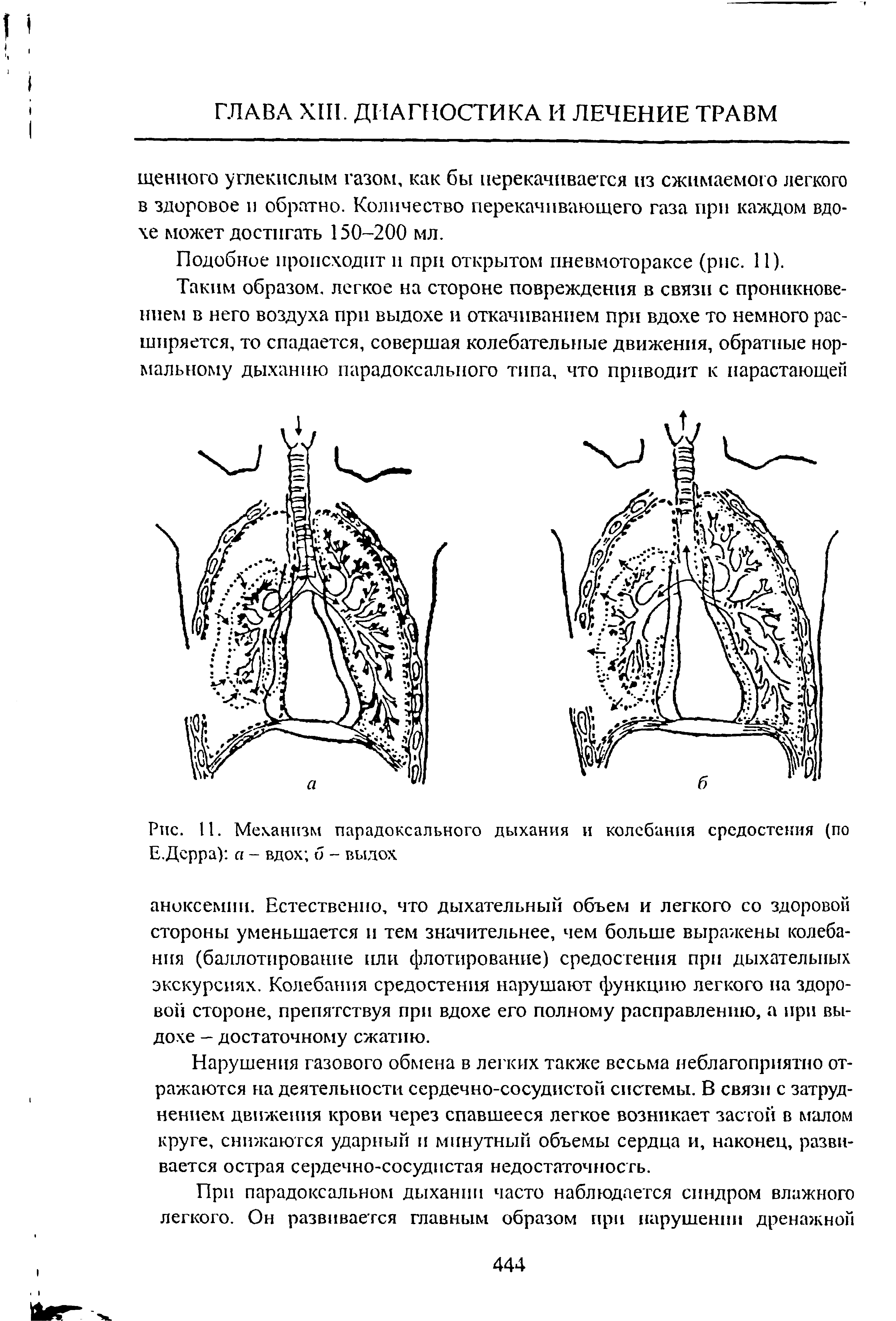 Рис. 11. Механизм парадоксального дыхания и колебания средостения (по Е.Дсрра) а - вдох б - выдох...