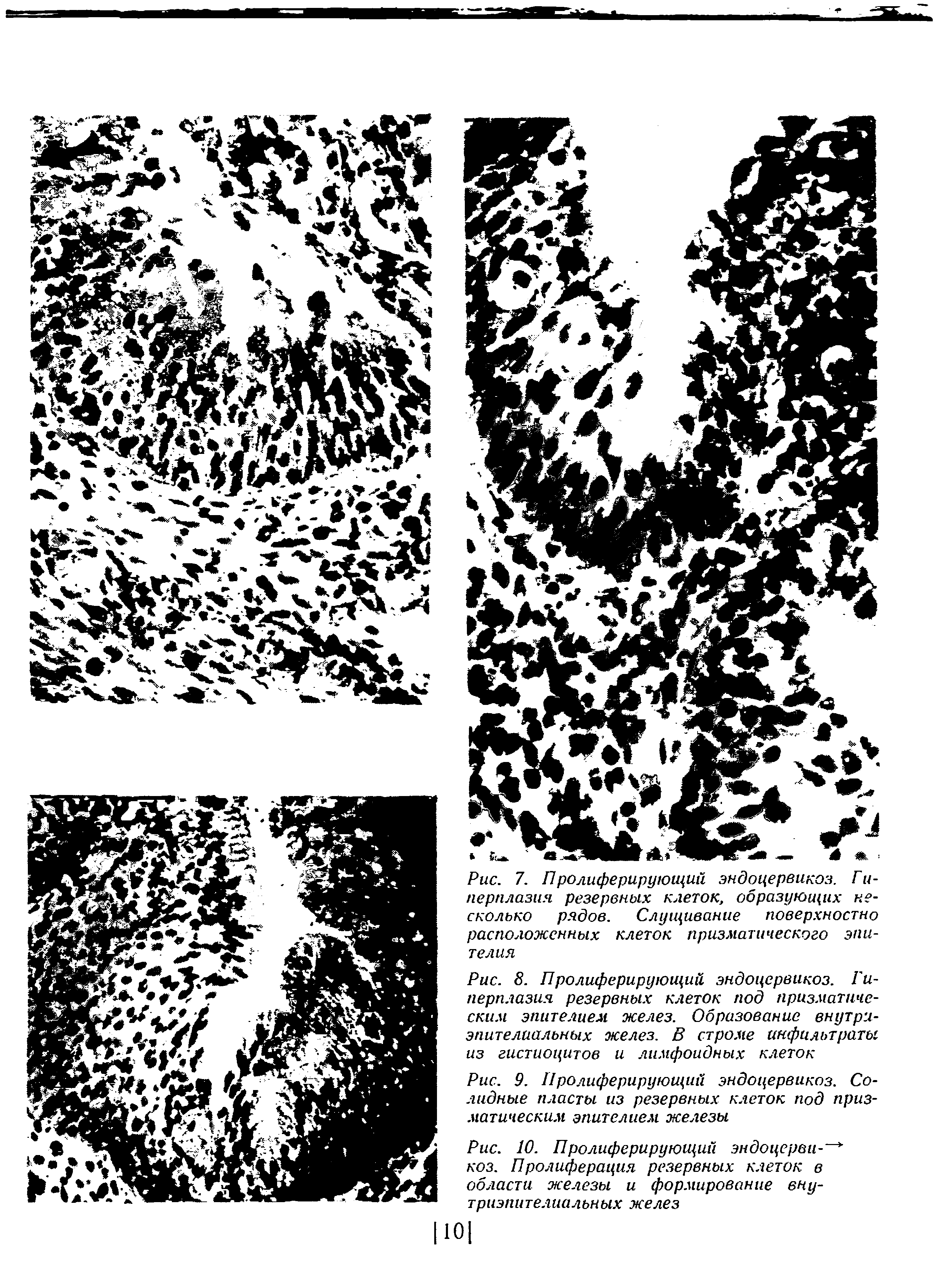 Рис. 9. Иролиферирующий эндоцервикоз. Солидные пласты из резервных клеток под призматическим эпителием железы...