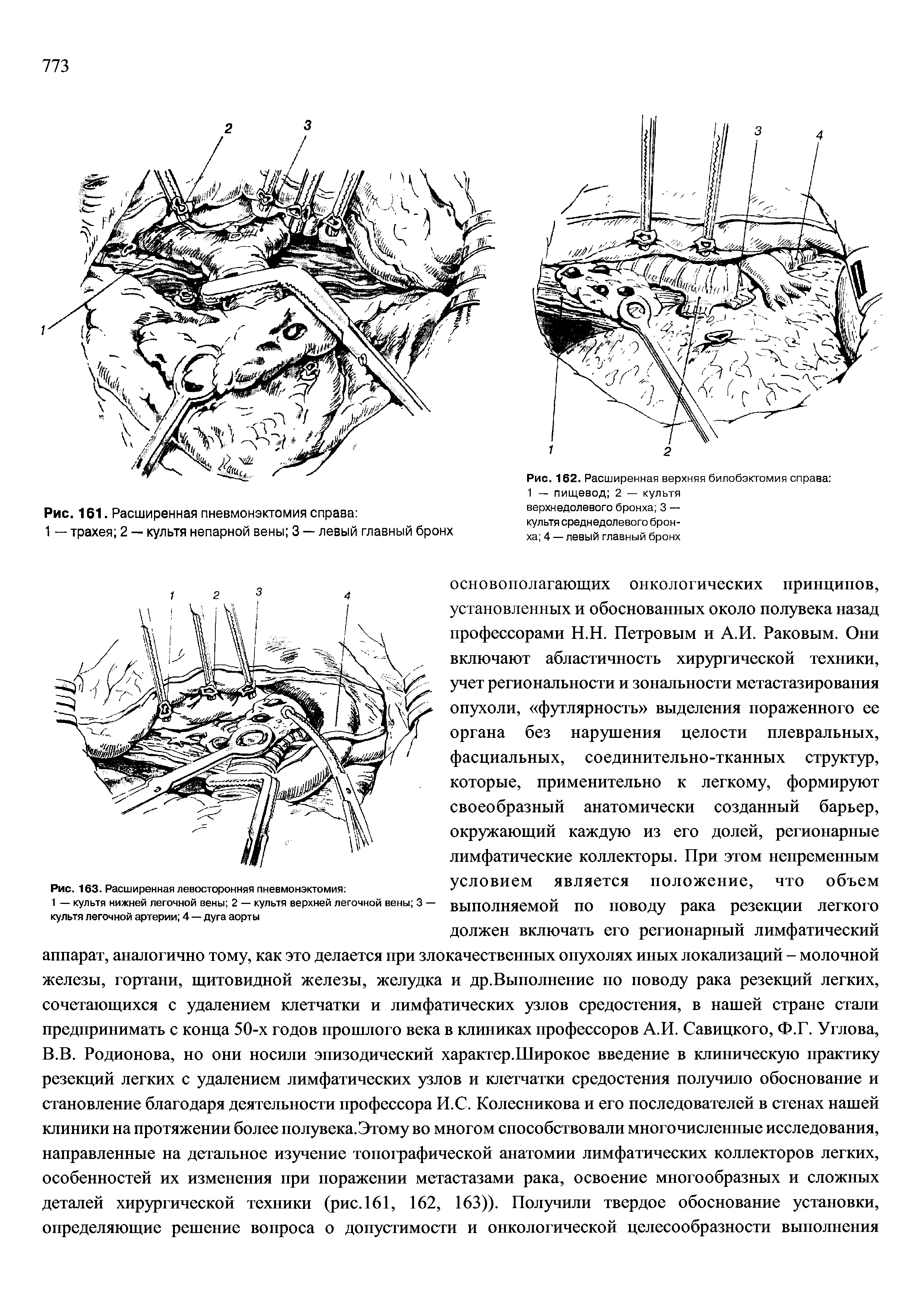 Рис. 162. Расширенная верхняя билобэктомия справа 1 — пищевод 2 — культя...