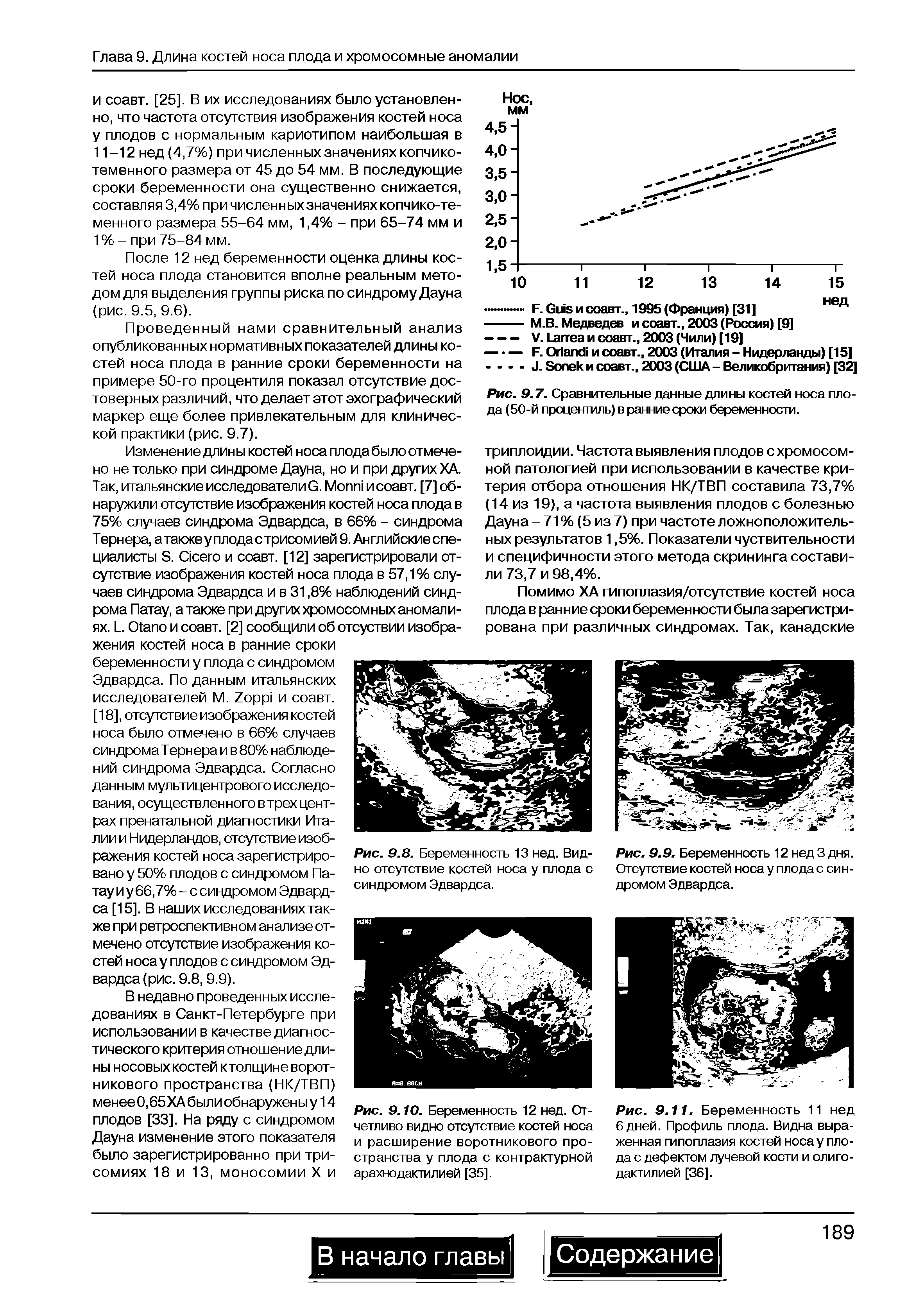 Рис. 9.11. Беременность 11 нед 6 дней. Профиль плода. Видна выраженная гипоплазия костей носа у плода с дефектом лучевой кости и олиго-дактилией [36].