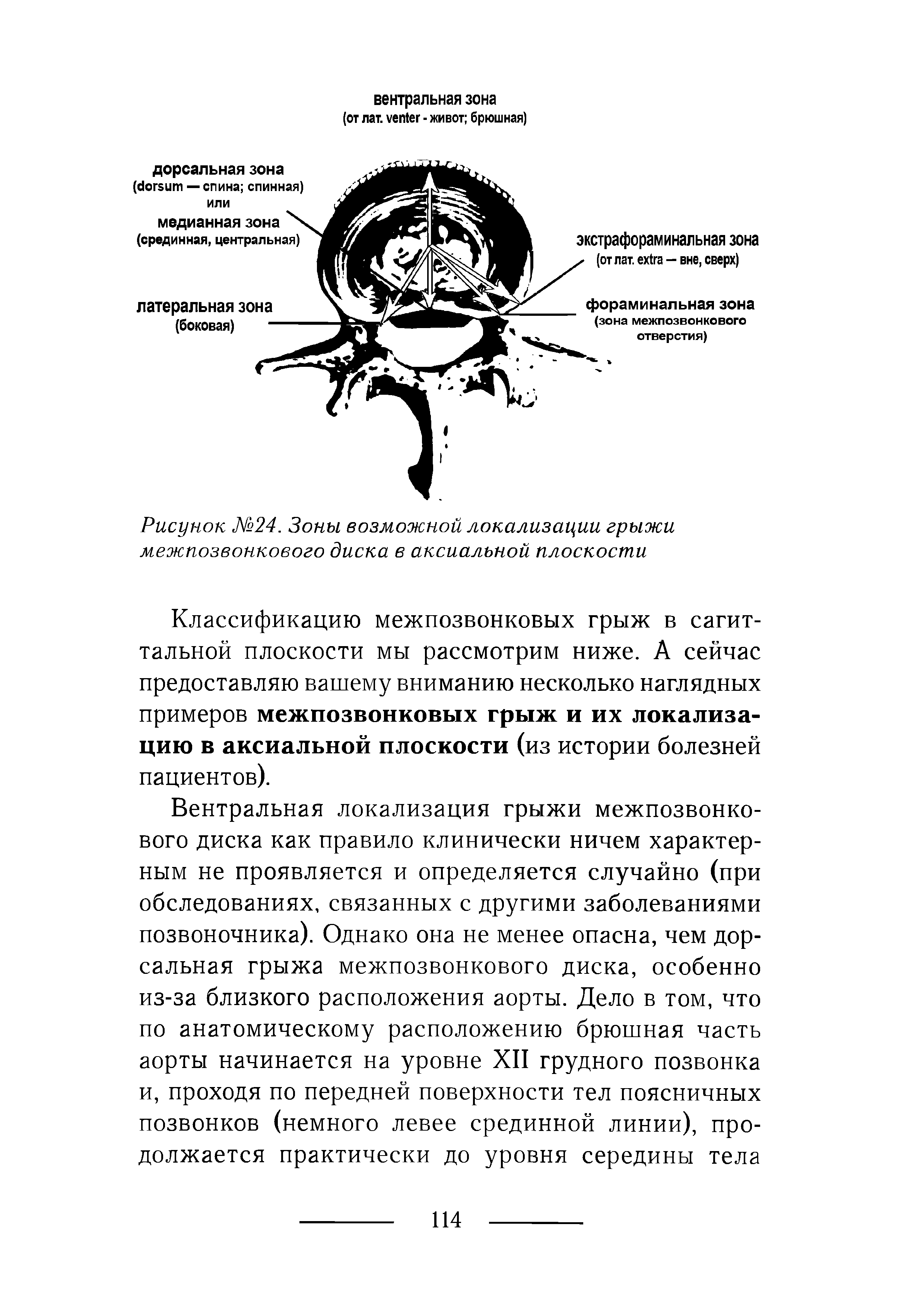 Рисунок №24. Зоны возможной локализации грыжи межпозвонкового диска в аксиальной плоскости...