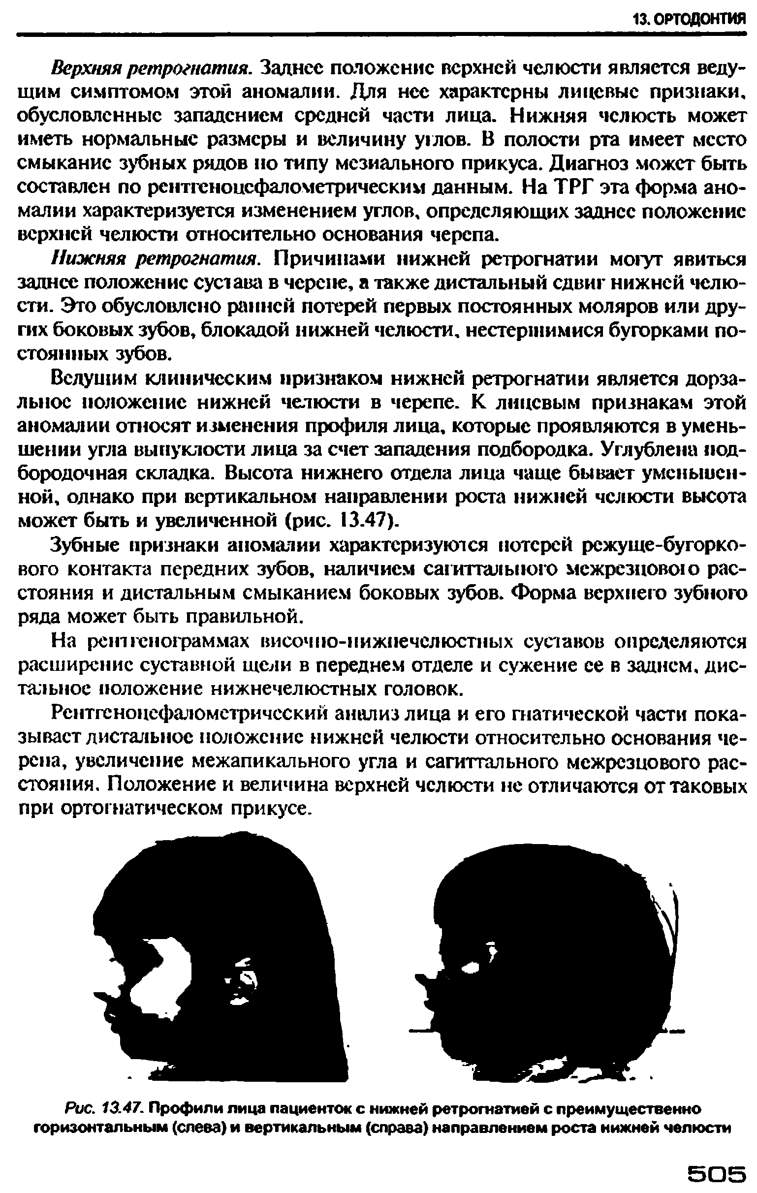 Рис. 13.47. Профили лица пациенток с нижней ретрогнатией с преимущественно горизонтальным (слева) и вертикальным (справа) направлением роста нижней челюсти...