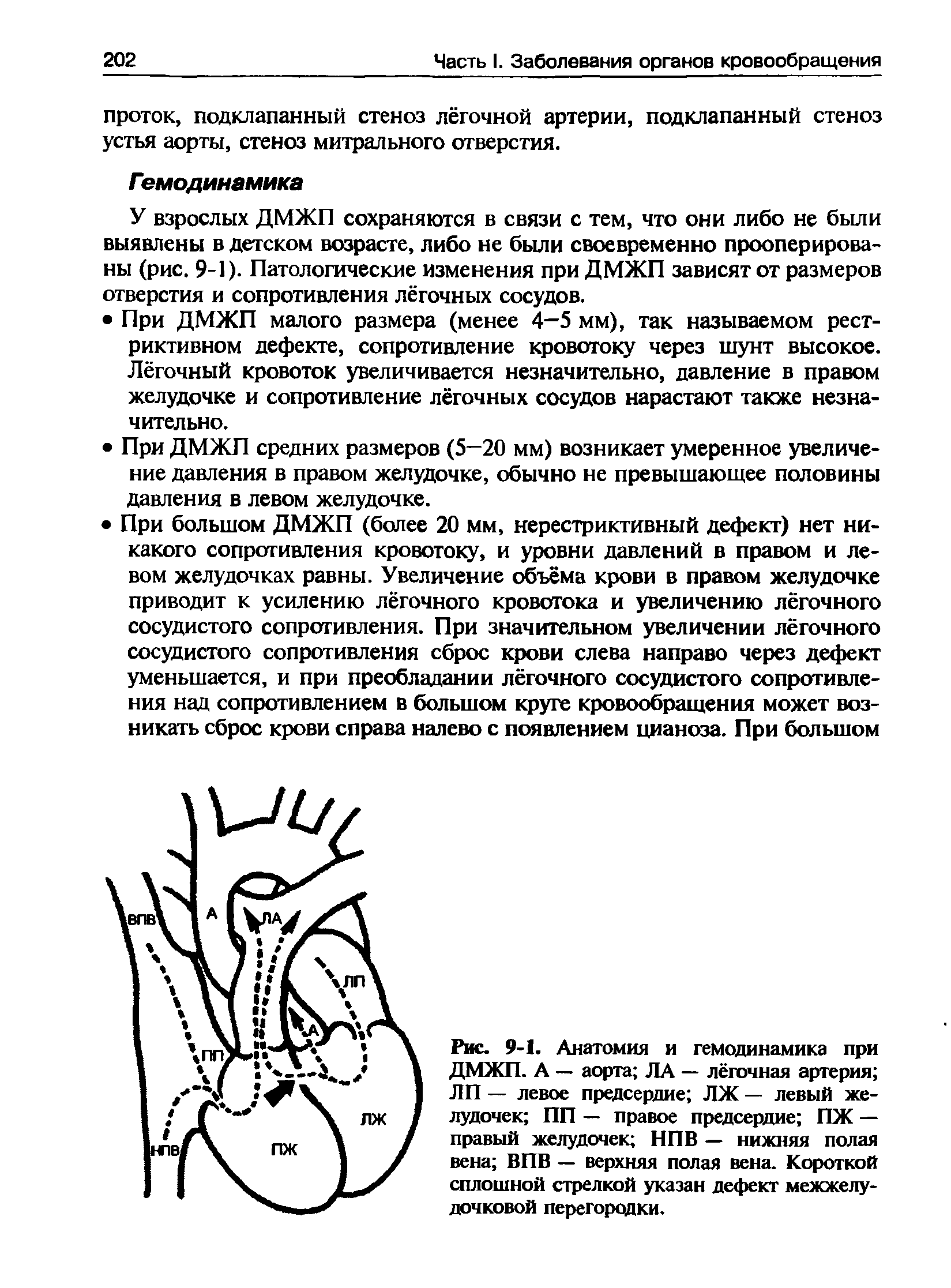 Рис. 9-1. Анатомия и гемодинамика при ДМЖП. А — аорта ЛА — лёгочная артерия ЛП — левое предсердие ЛЖ — левый желудочек ПП — правое предсердие ПЖ — правый желудочек НПВ — нижняя полая вена ВПВ — верхняя полая вена. Короткой сплошной стрелкой указан дефект межжелудочковой перегородки.