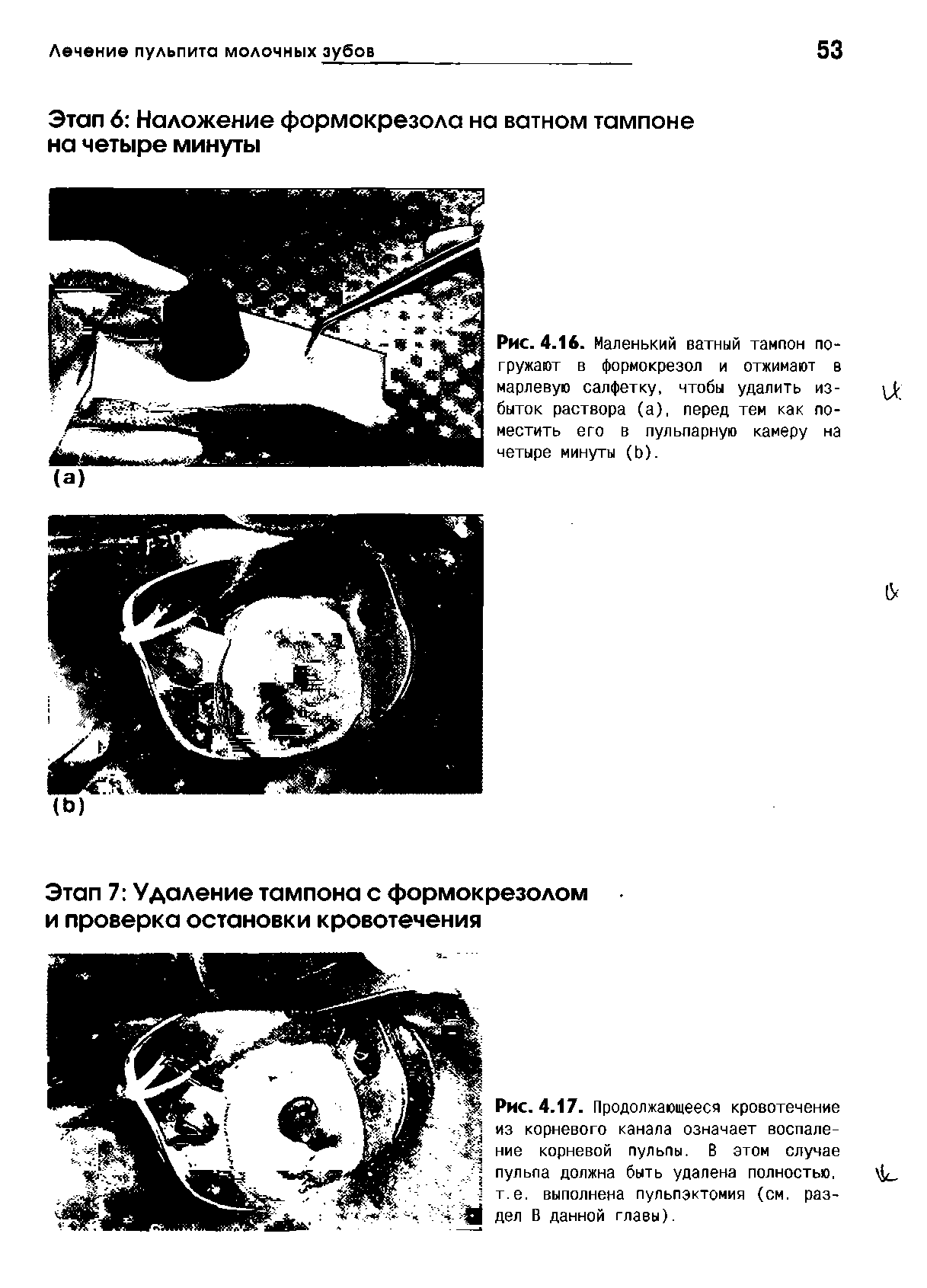 Рис. 4.17. Продолжающееся кровотечение из корневого канала означает воспаление корневой пульпы. В этом случае пульпа должна быть удалена полностью, т.е. выполнена пульпэктомия (см. раздел В данной главы).