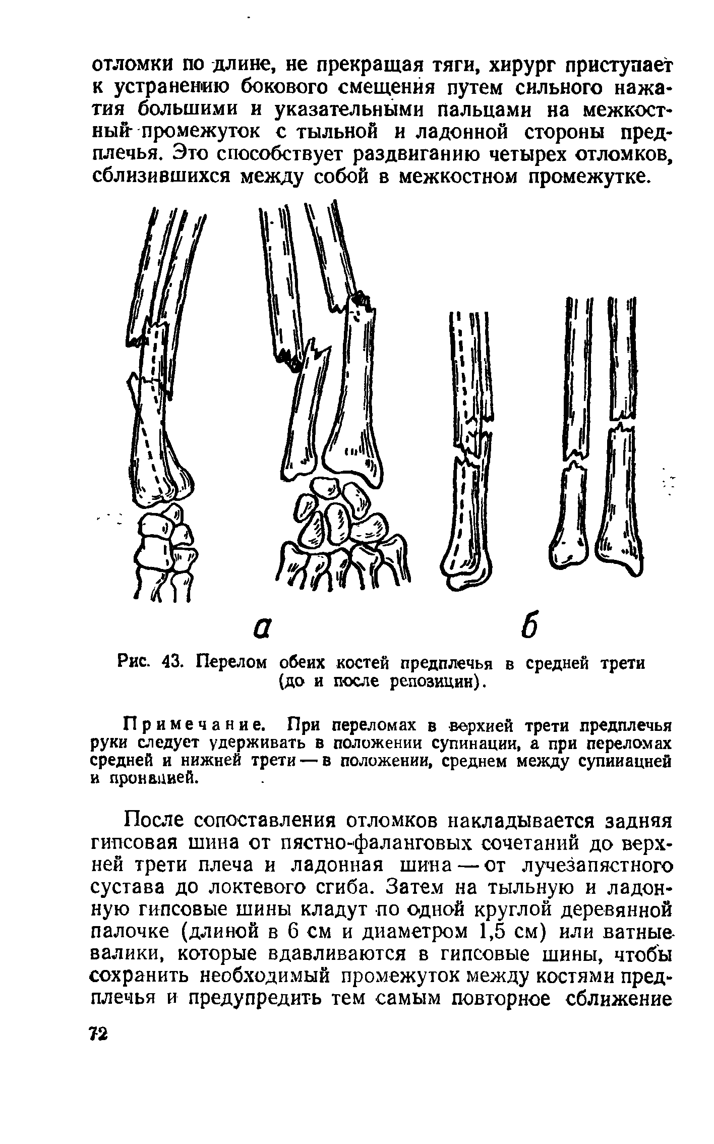 Рис. 43. Перелом обеих костей предплечья в средней трети (до и после репозиции).