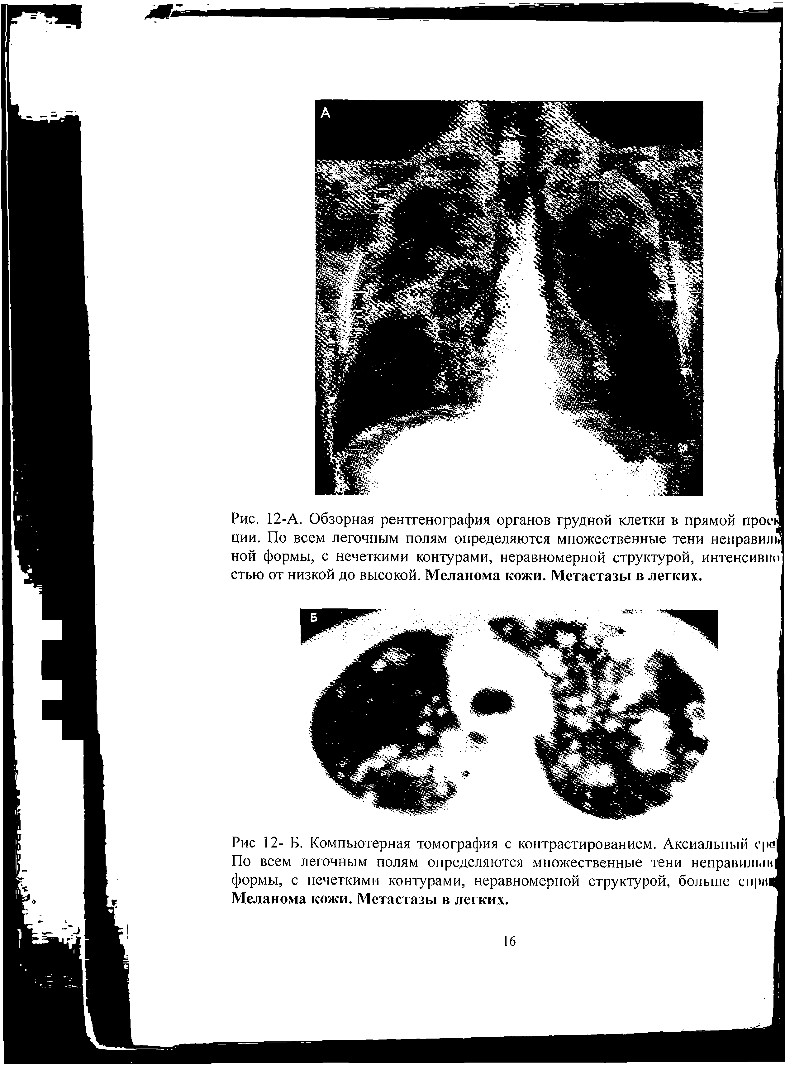 Рис. 12-А. Обзорная рентгенография органов грудной ции. По всем легочным полям определяются множественные тени ной формы, с нечеткими контурами, неравномерной структурой, I стью от низкой до высокой. Меланома кожи. Метастазы в легких.