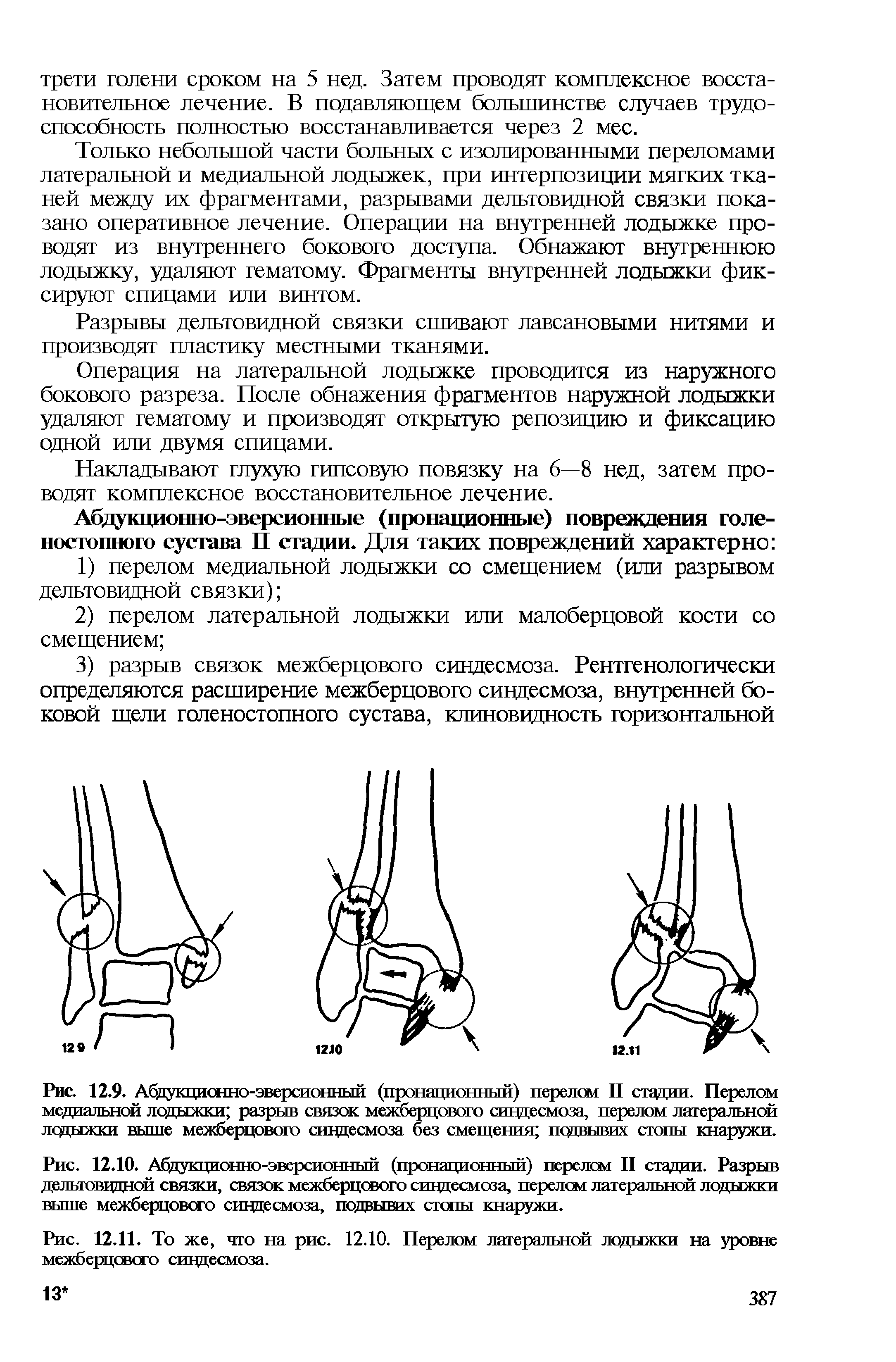 Рис. 12.10. Абдукционно-эверсионный (пронационный) перелсм II стадии. Разрыв дельтоввдной связки, связок межберцового сивдесмоза, перелом латеральной лодыжки выше межберцового сивдесмоза, подаывих степы кнаружи.