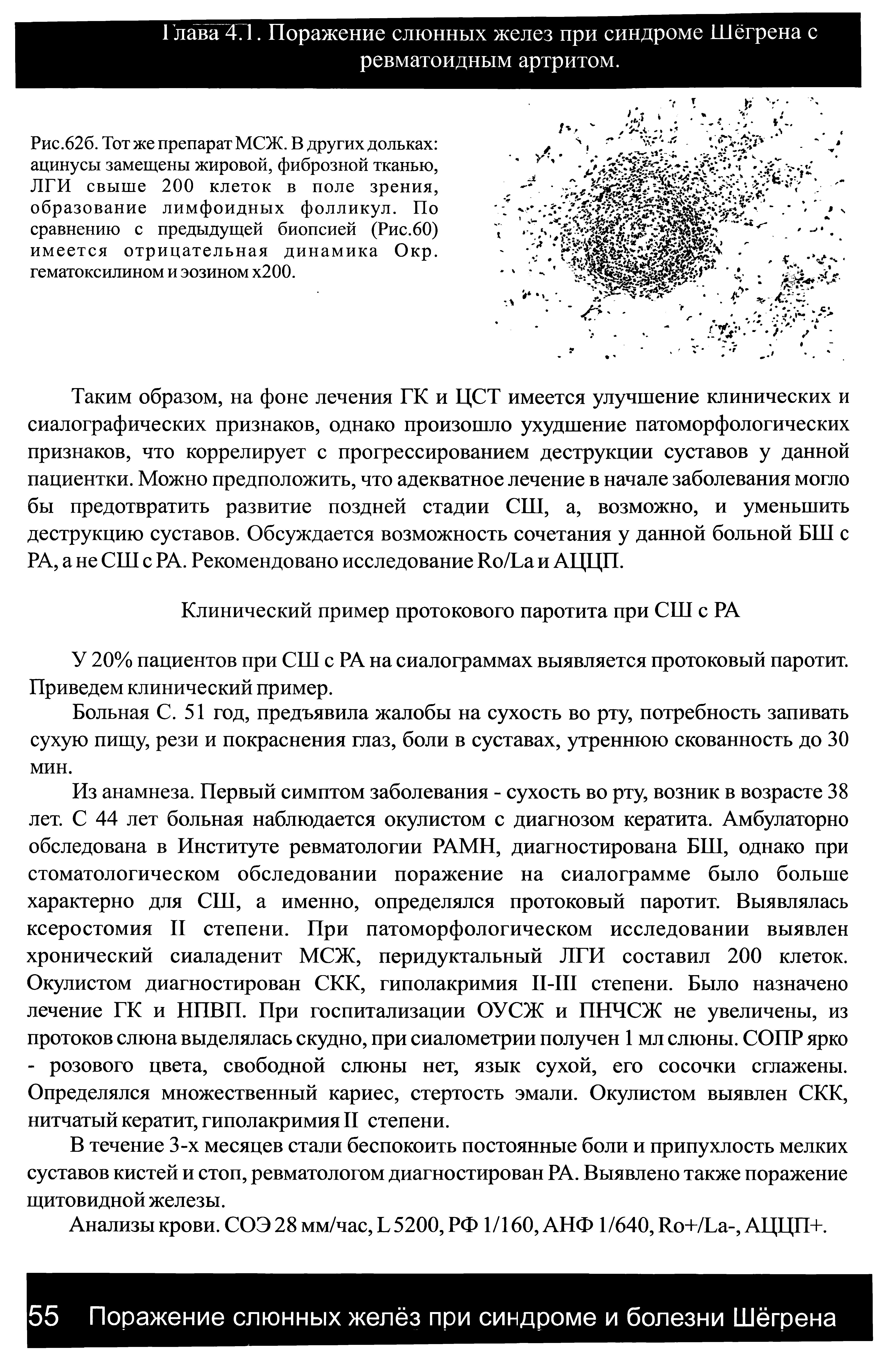 Рис.62б. Тот же препарат МСЖ. В других дольках ацинусы замещены жировой, фиброзной тканью, ЛГИ свыше 200 клеток в поле зрения, образование лимфоидных фолликул. По сравнению с предыдущей биопсией (Рис.60) имеется отрицательная динамика Окр. гематоксилином и эозином х200.