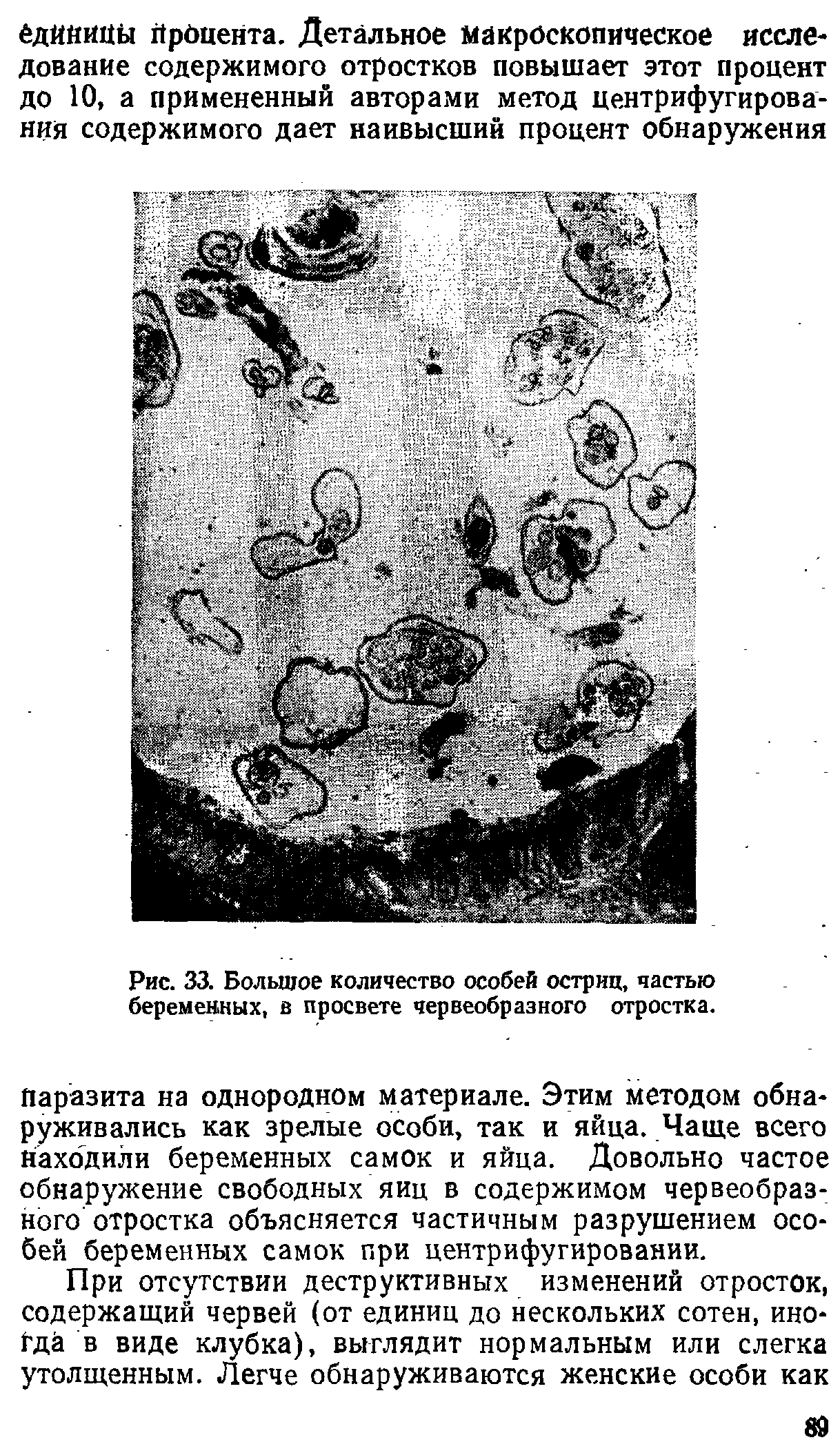 Рис. 33. Большое количество особей остриц, частью беременных, в просвете червеобразного отростка.