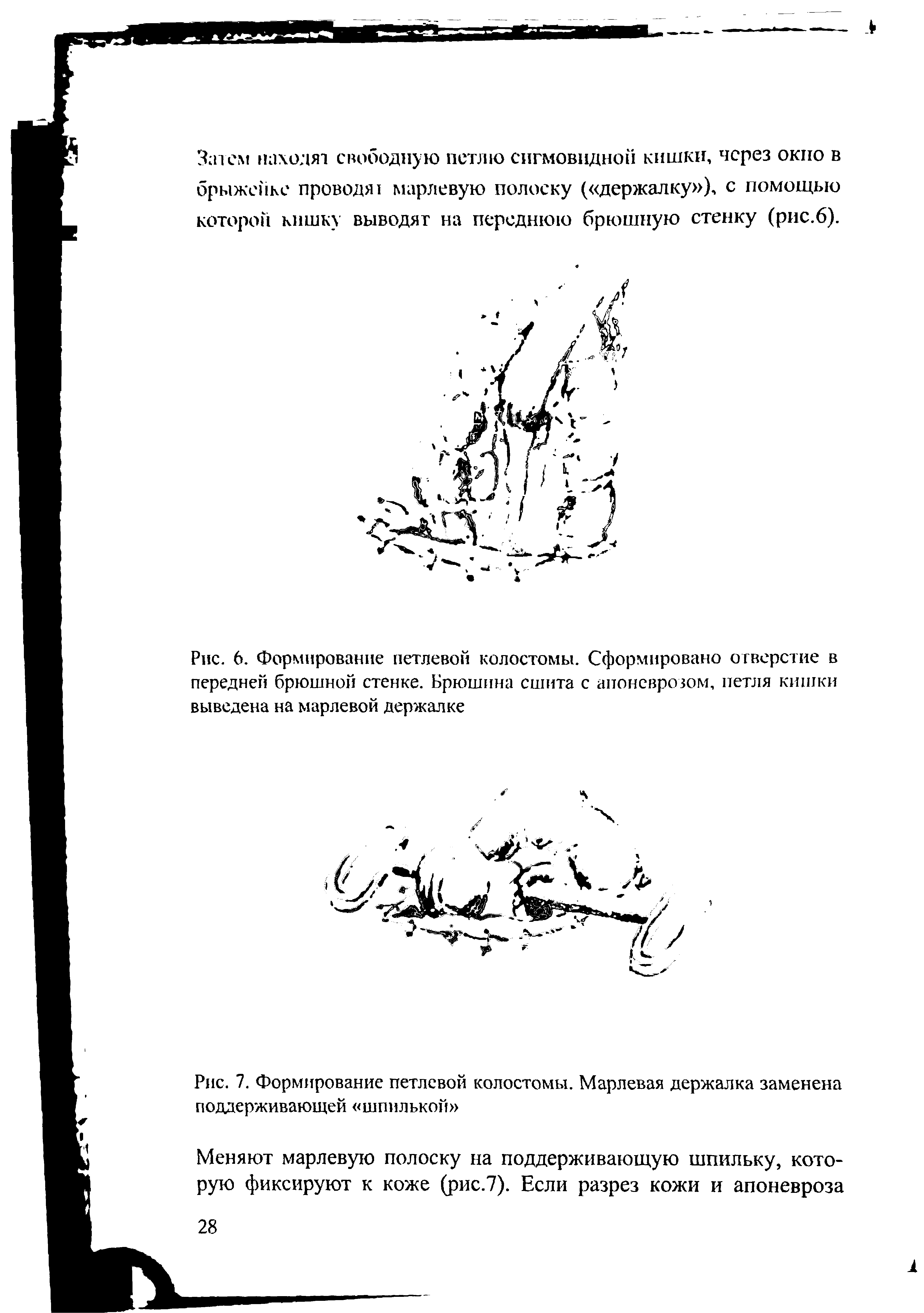 Рис. 6. Формирование петлевой колостомы. Сформировано отверстие в передней брюшной стенке. Брюшина сшита с апоневрозом, петля кишки выведена на марлевой держалке...