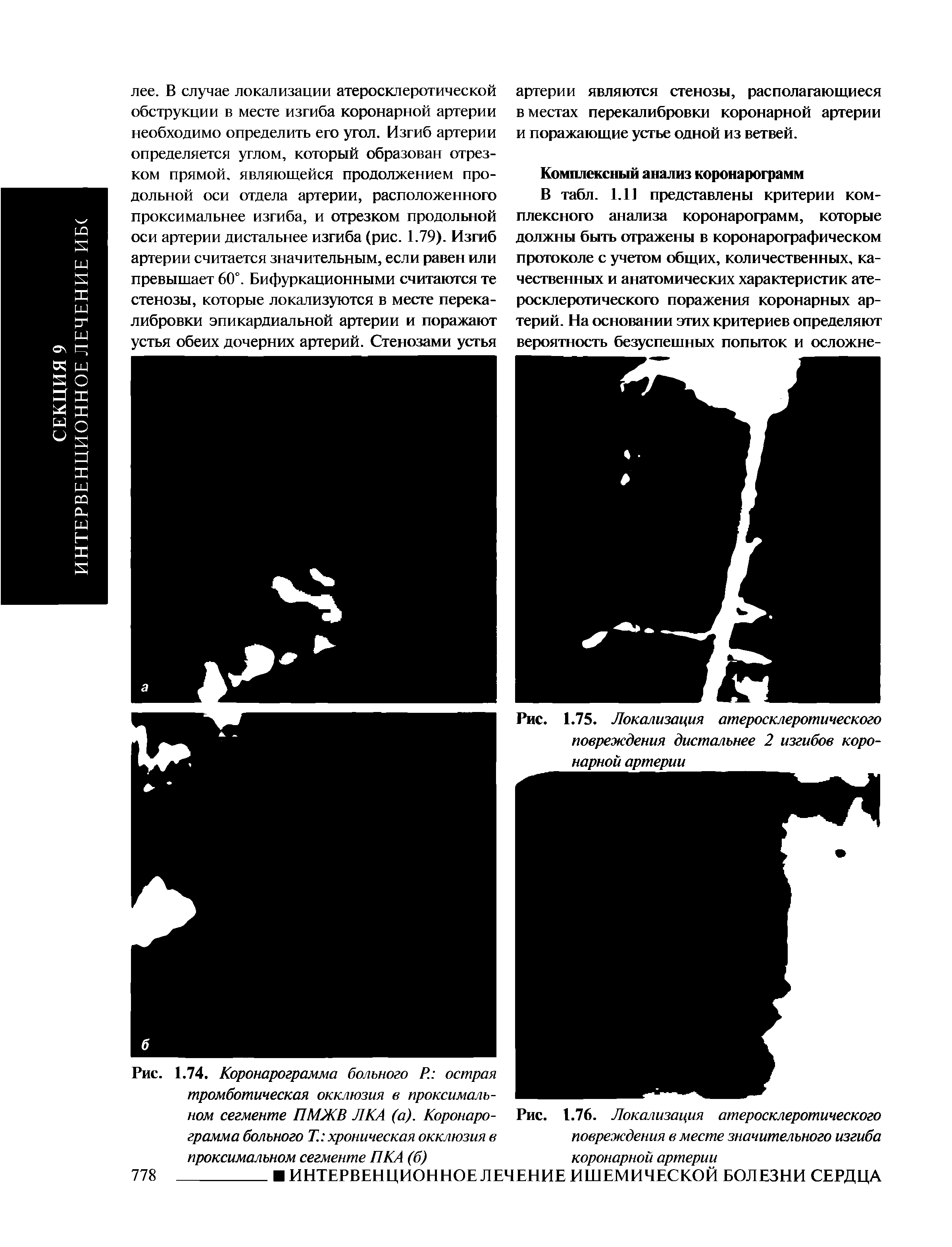 Рис. 1.74. Коронарограмма больного Р. острая тромботическая окклюзия в проксимальном сегменте ПМЖВ ЛКА (а). Коронарограмма больного Т. хроническая окклюзия в проксимальном сегменте ПКА (б)...