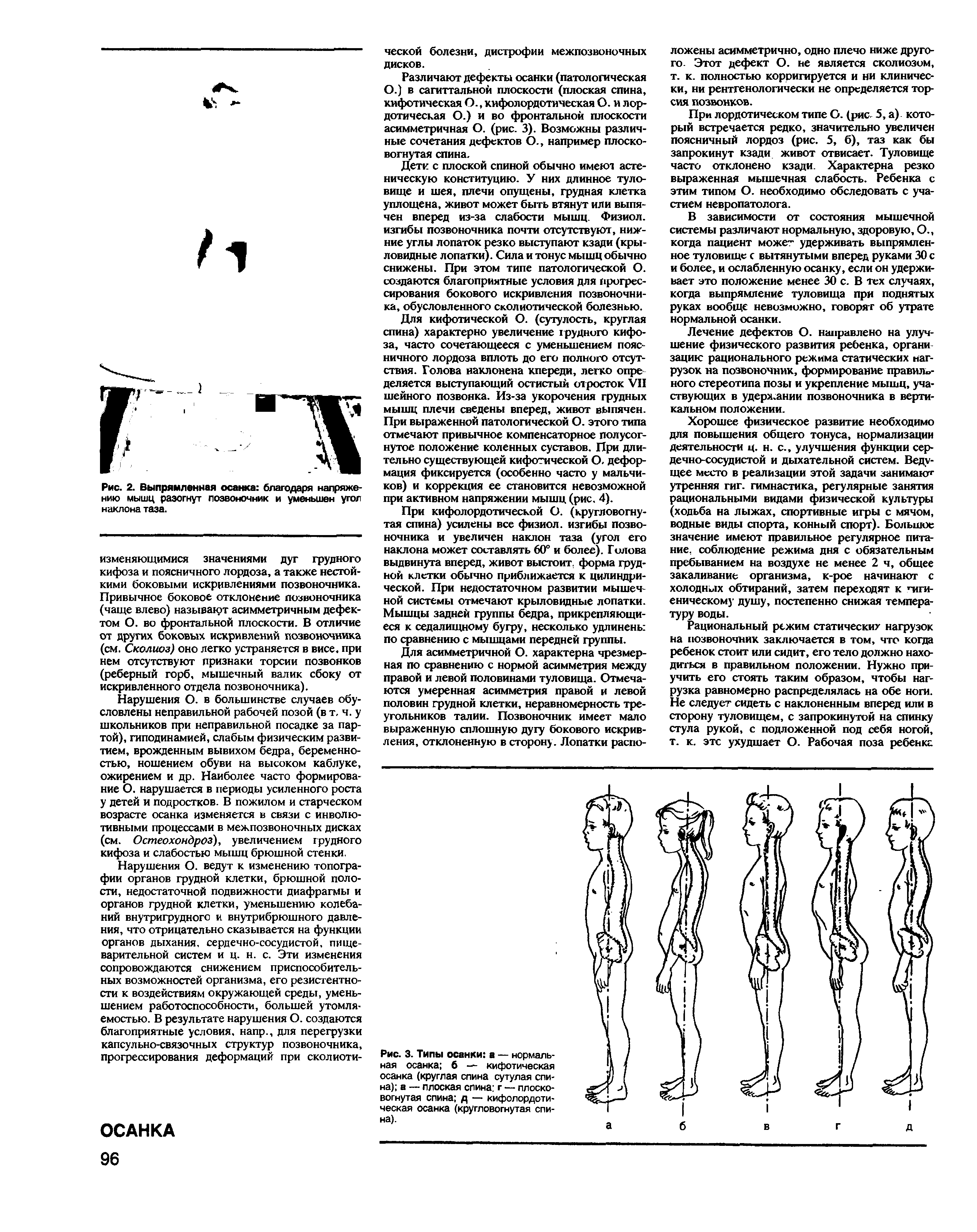 Рис. 3. Типы осанки а — нормальная осанка 6 — кифотическая осанка (круглая спина сутулая спина) а — плоская спина г — плоско-вогнутая спина д — кифолордотическая осанка (кругловогнутая спина).