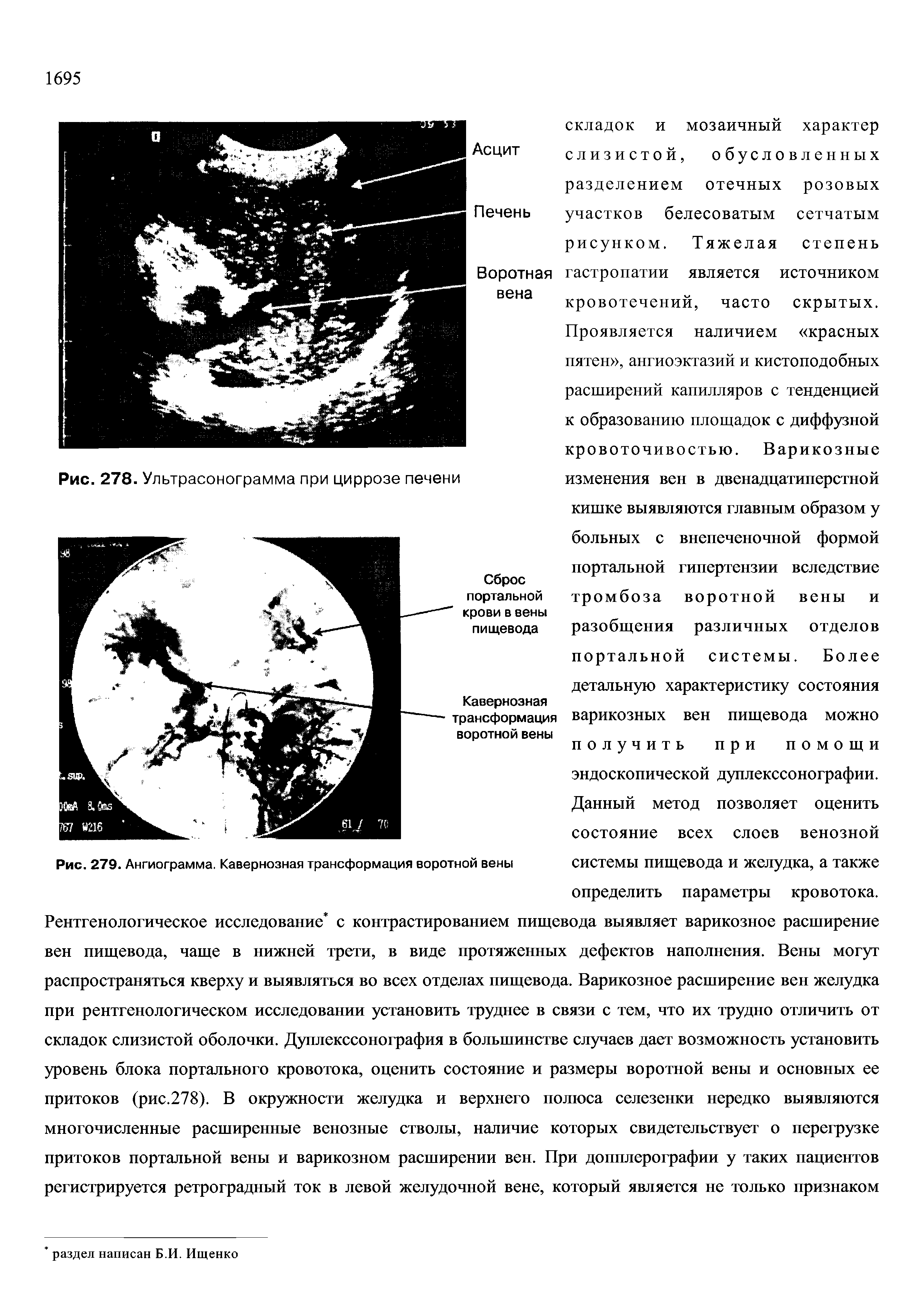 Рис. 279. Ангиограмма. Кавернозная трансформация воротной вены системы пищевода и желудка, а также...