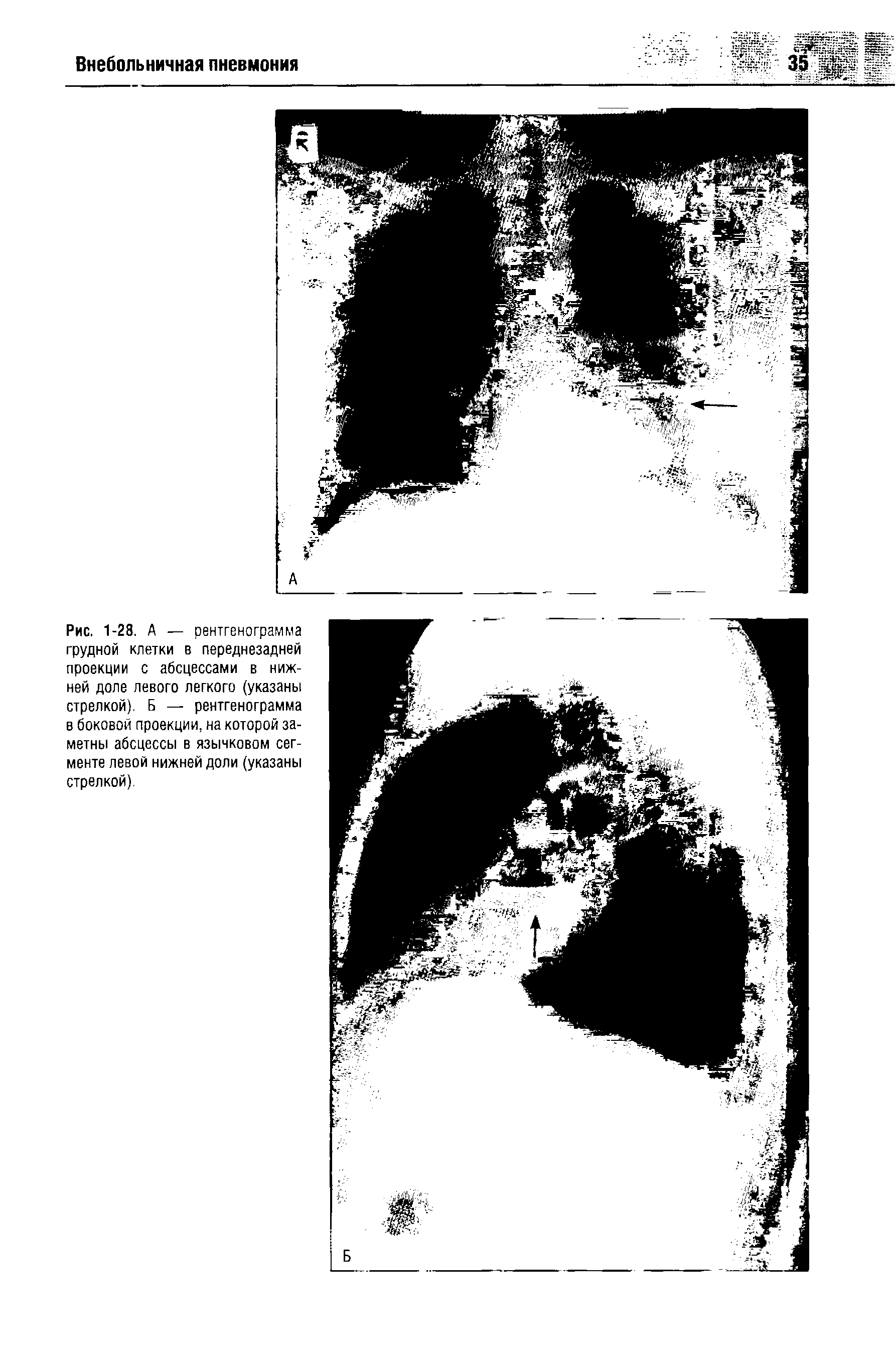 Рис. 1-28. А — рентгенограмма грудной клетки в переднезадней проекции с абсцессами в нижней доле левого легкого (указаны стрелкой). Б — рентгенограмма в боковой проекции, на которой заметны абсцессы в язычковом сегменте левой нижней доли (указаны стрелкой).