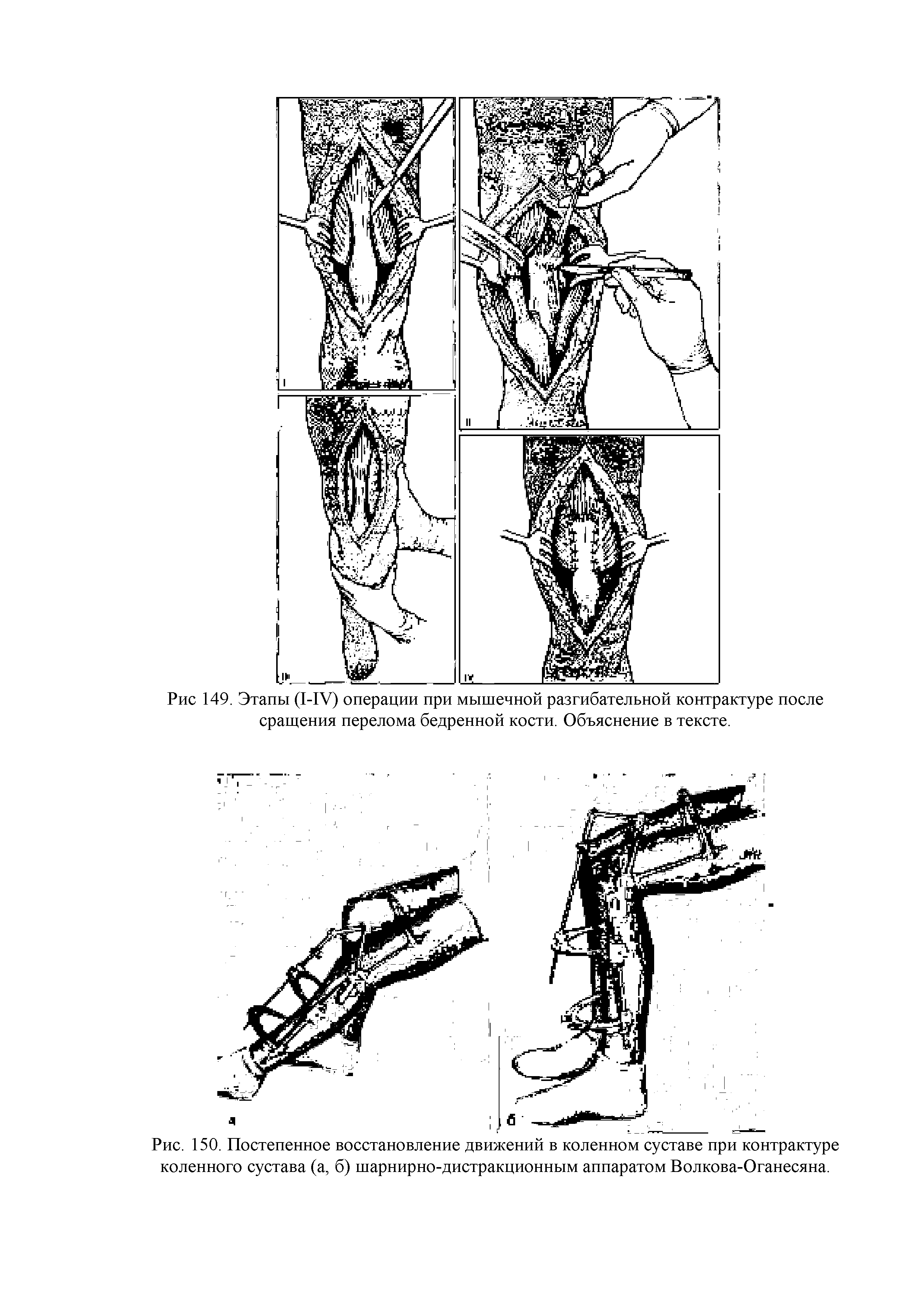 Рис. 150. Постепенное восстановление движений в коленном суставе при контрактуре коленного сустава (а, б) шарнирно-дистракционным аппаратом Волкова-Оганесяна.