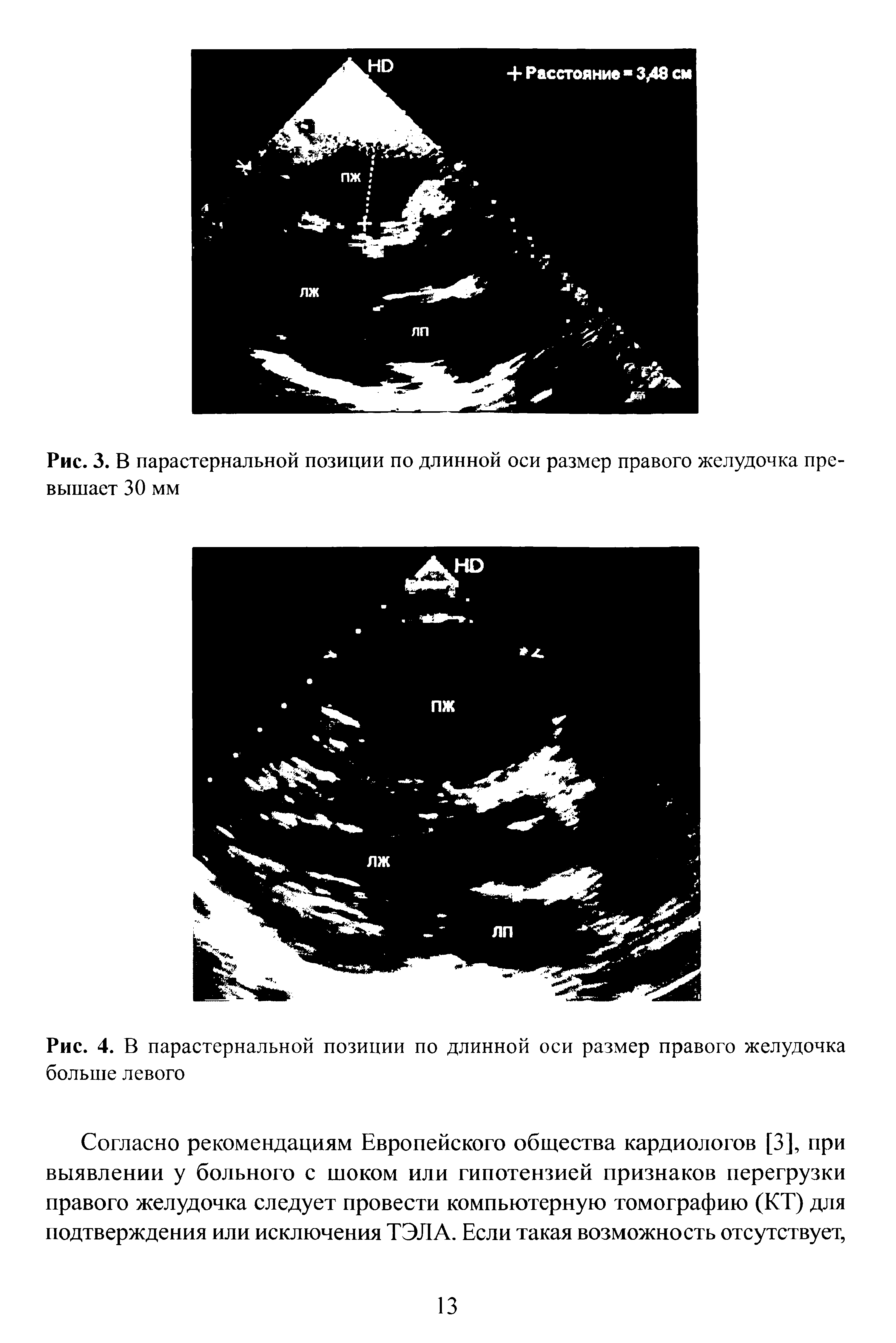 Рис. 3. В парастернальной позиции по длинной оси размер правого желудочка превышает 30 мм...