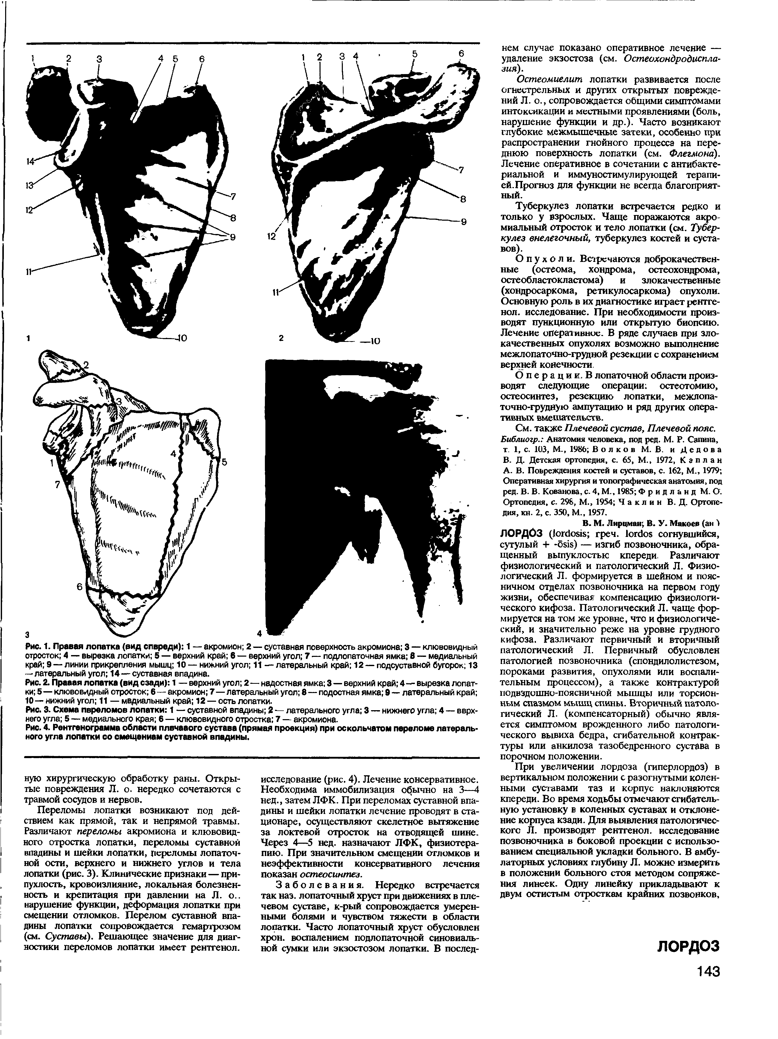 Рис. 2. Прааая лопатка (вид сзади) 1 — верхний угол 2—надостная ямка 3 — верхний край 4—вырезка лопатки 5—клювовидный отросток 6—акромион 7—латеральный угол 8 — подостная ямка 9 — латеральный край 10— нижний угол 11 — медиальный край 12 — ость лопатки.