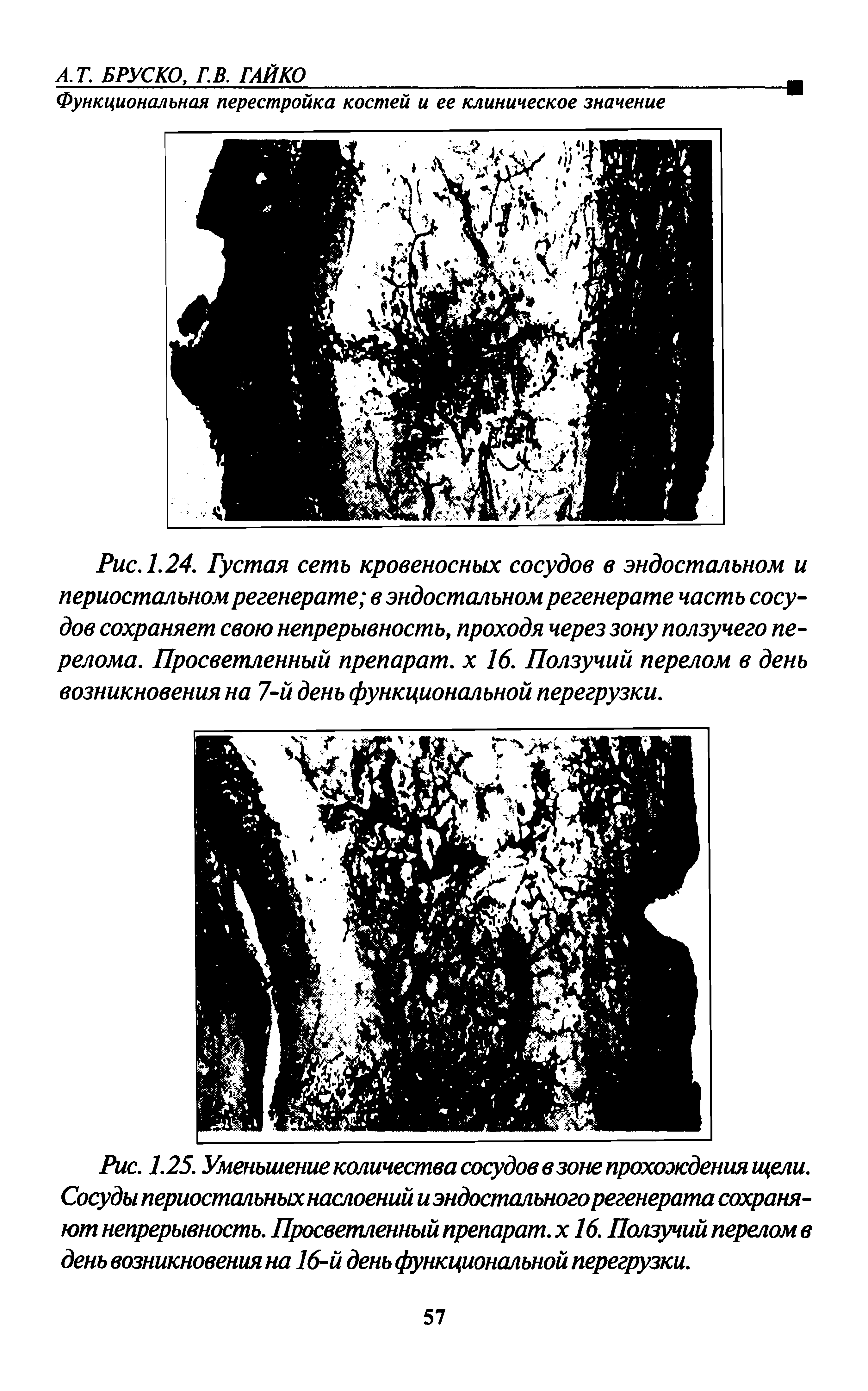 Рис.1.24. Густая сеть кровеносных сосудов в эндостальном и периостальном регенерате в эндостальном регенерате часть сосудов сохраняет свою непрерывность, проходя через зону ползучего перелома. Просветленный препарат, х 16. Ползучий перелом в день возникновения на 7-й день функциональной перегрузки.