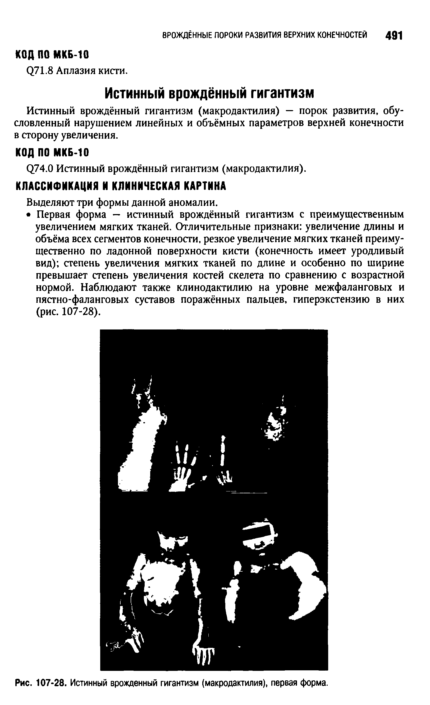 Рис. 107-28. Истинный врожденный гигантизм (макродактилия), первая форма.