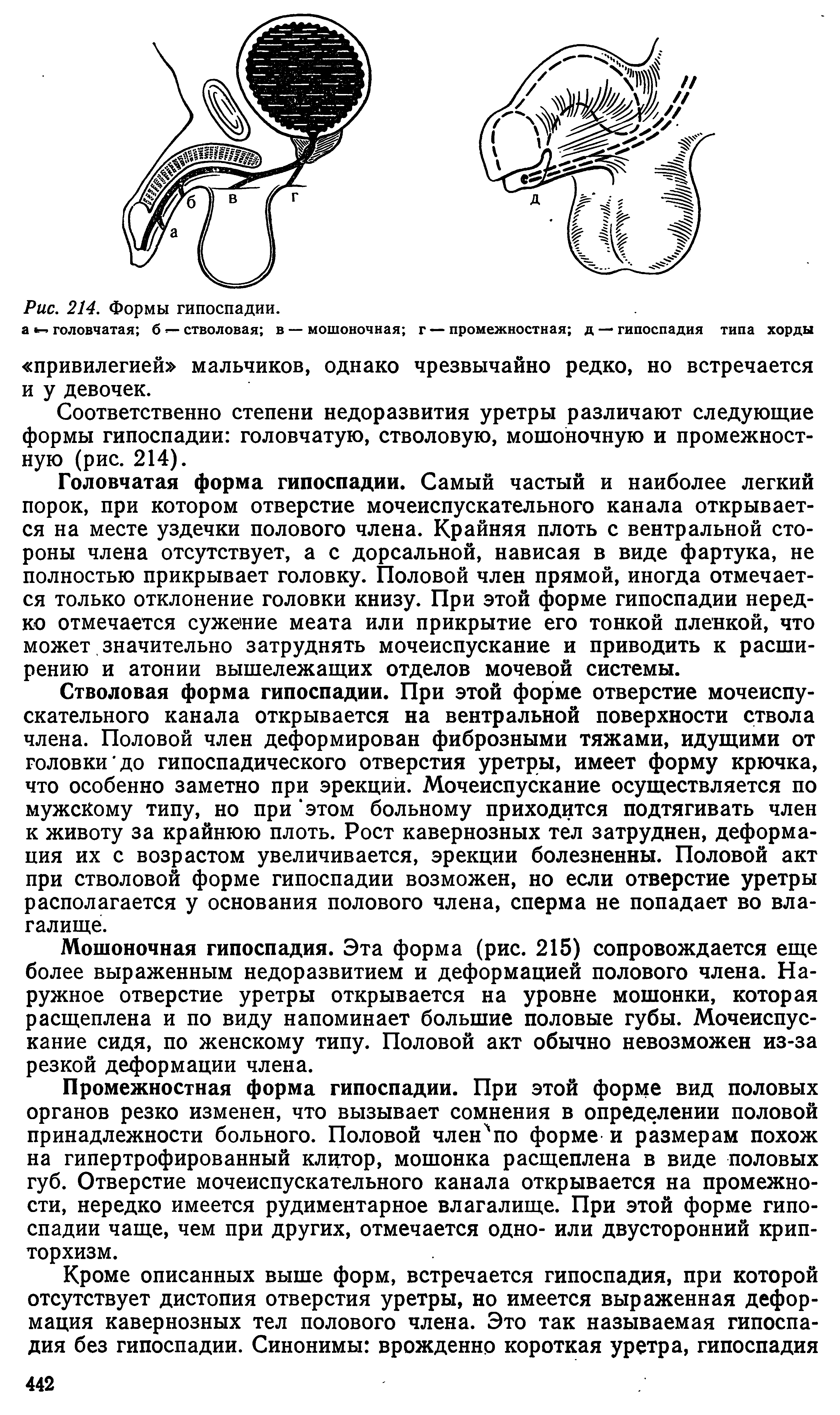 Рис. 214. Формы гипоспадии, а головчатая б стволовая в — мошоночная г — промежностная д — гипоспадия типа хорды...