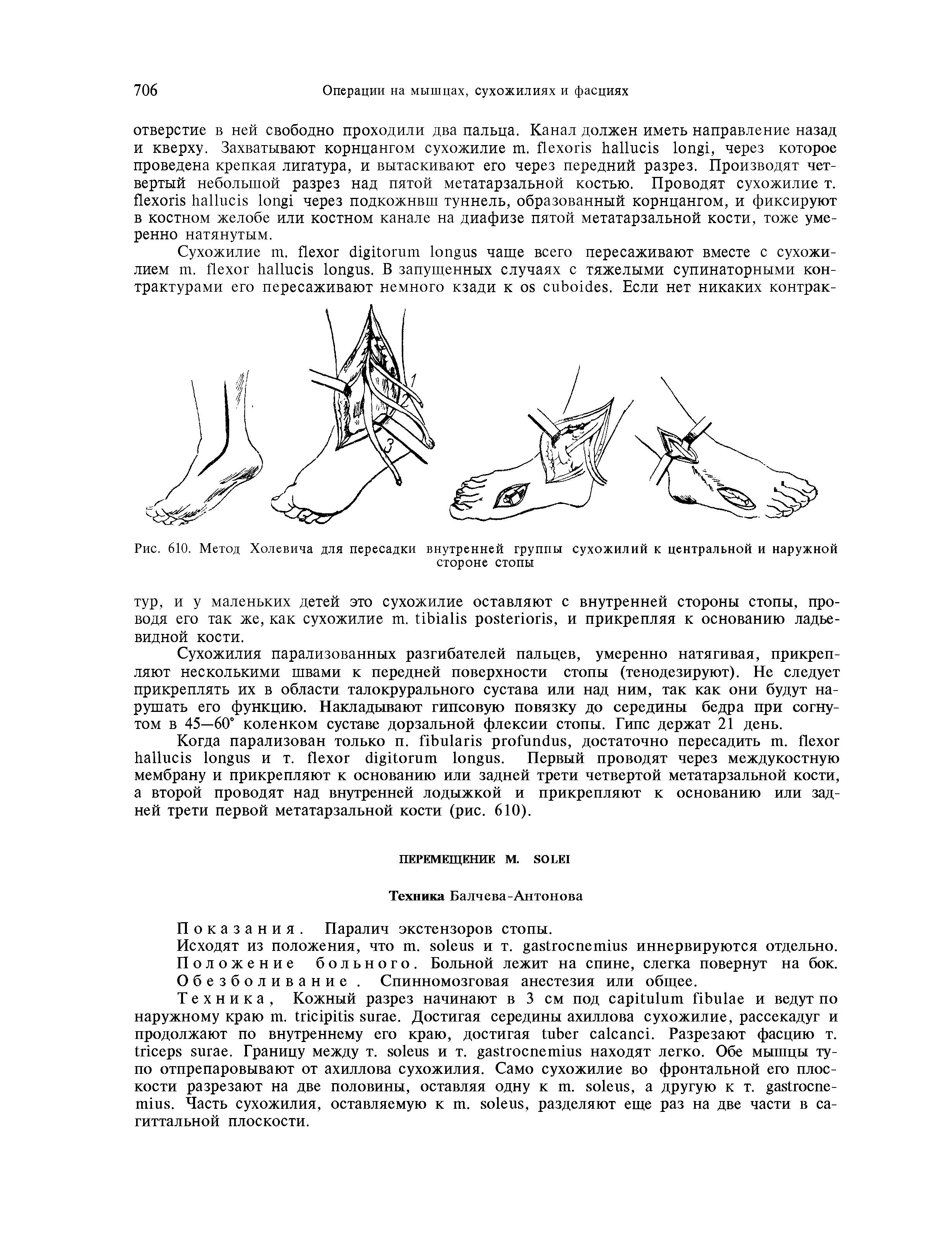 Рис. 610. Метод Холевича для пересадки внутренней группы сухожилий к центральной и наружной стороне стопы...