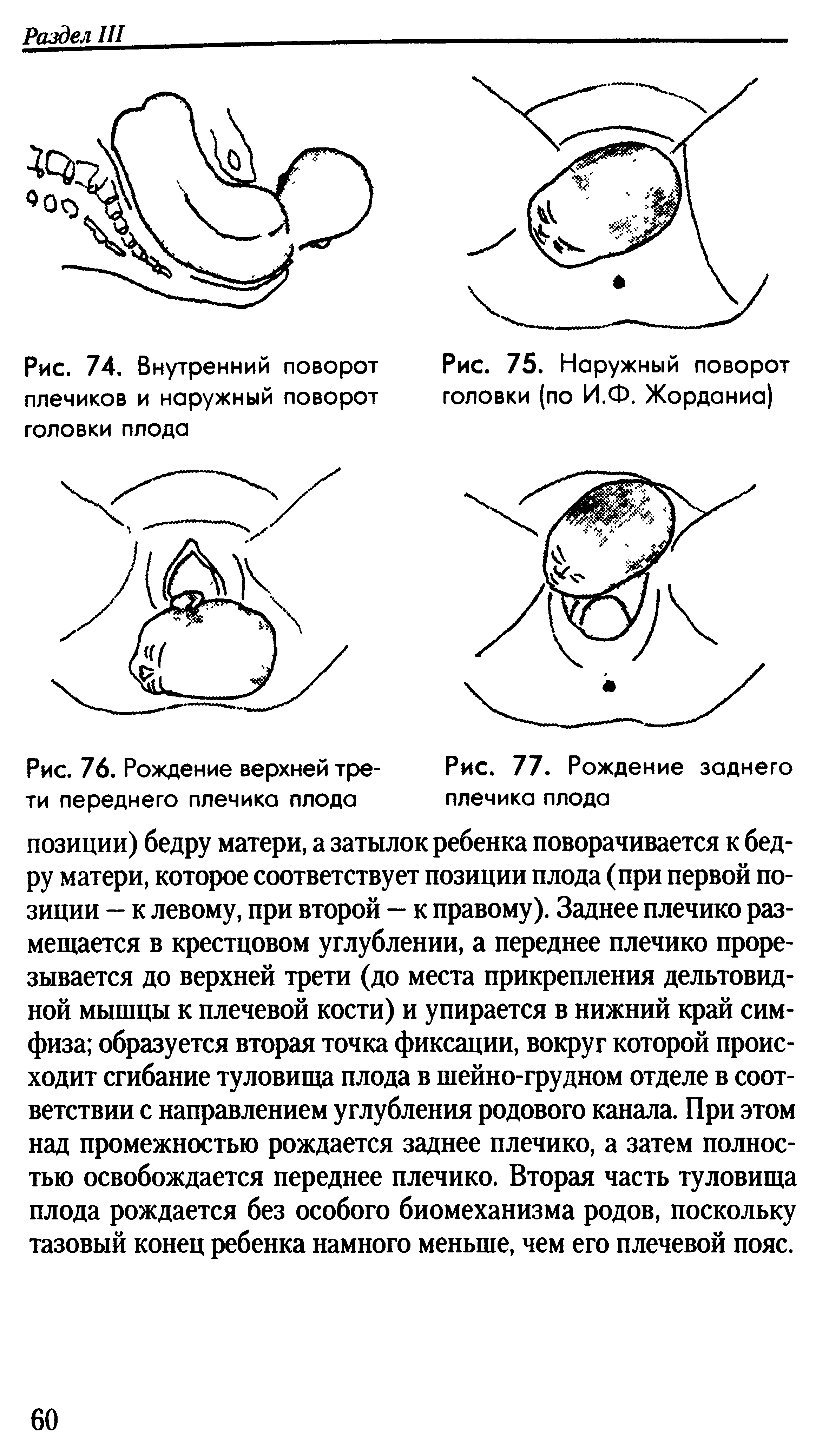 Рис. 76. Рождение верхней трети переднего плечика плода...