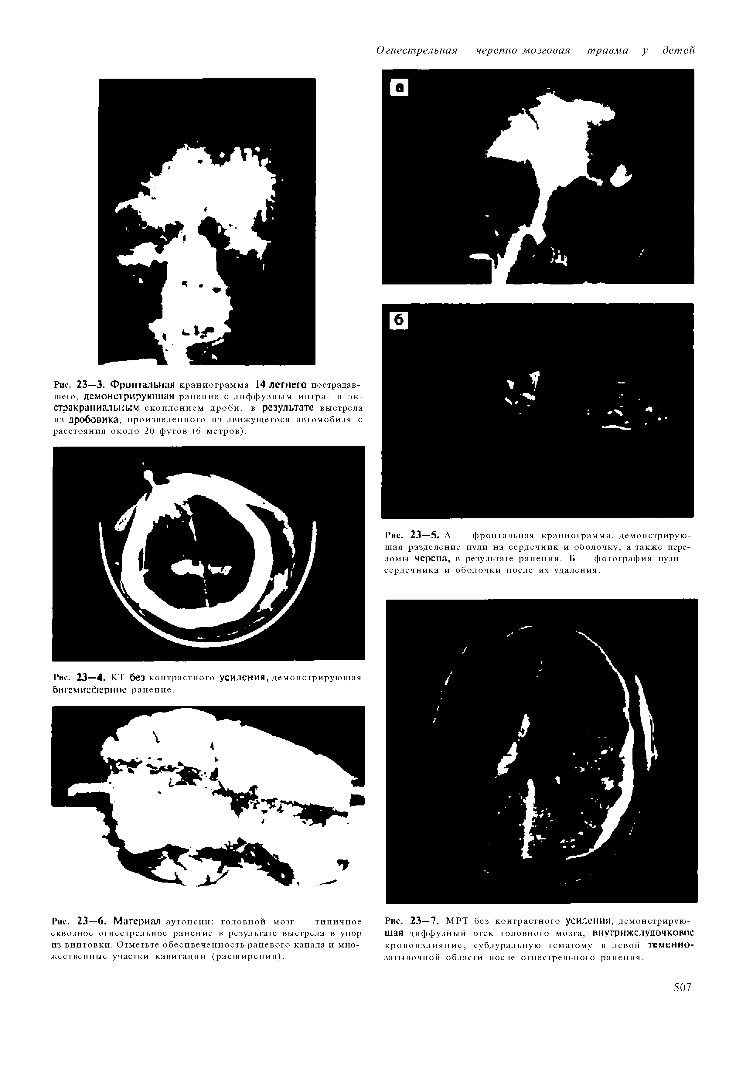 Рис. 23—7. МРТ без контрастного уСИЛСНИЯ, демонстрирующая диффузный отек головного мозга, ВНутрИЖелуДОЧКОВОС кровоизлияние, субдуральную гематому в левой теменнозатылочной области после огнестрельного ранения.