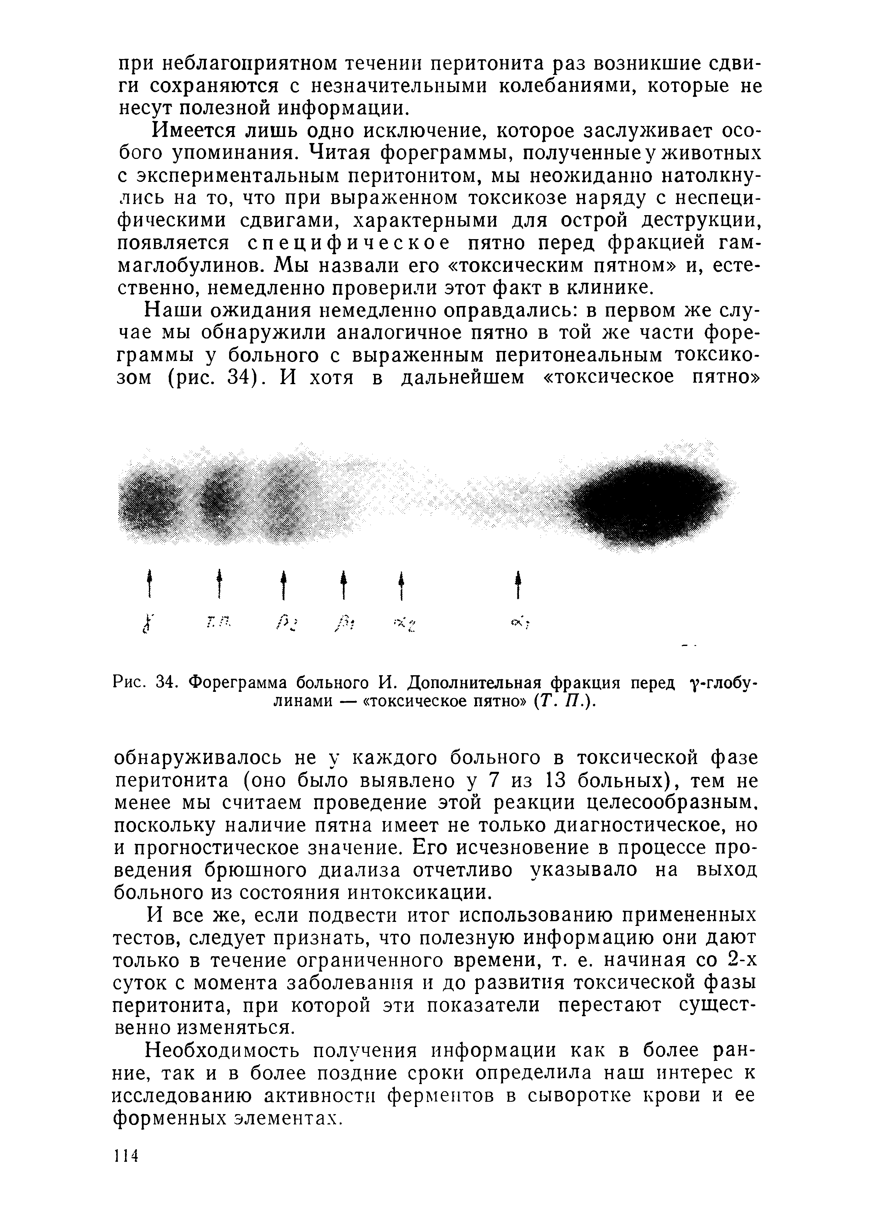 Рис. 34. Фореграмма больного И. Дополнительная фракция перед у-глобу линами — токсическое пятно (Т. П.).