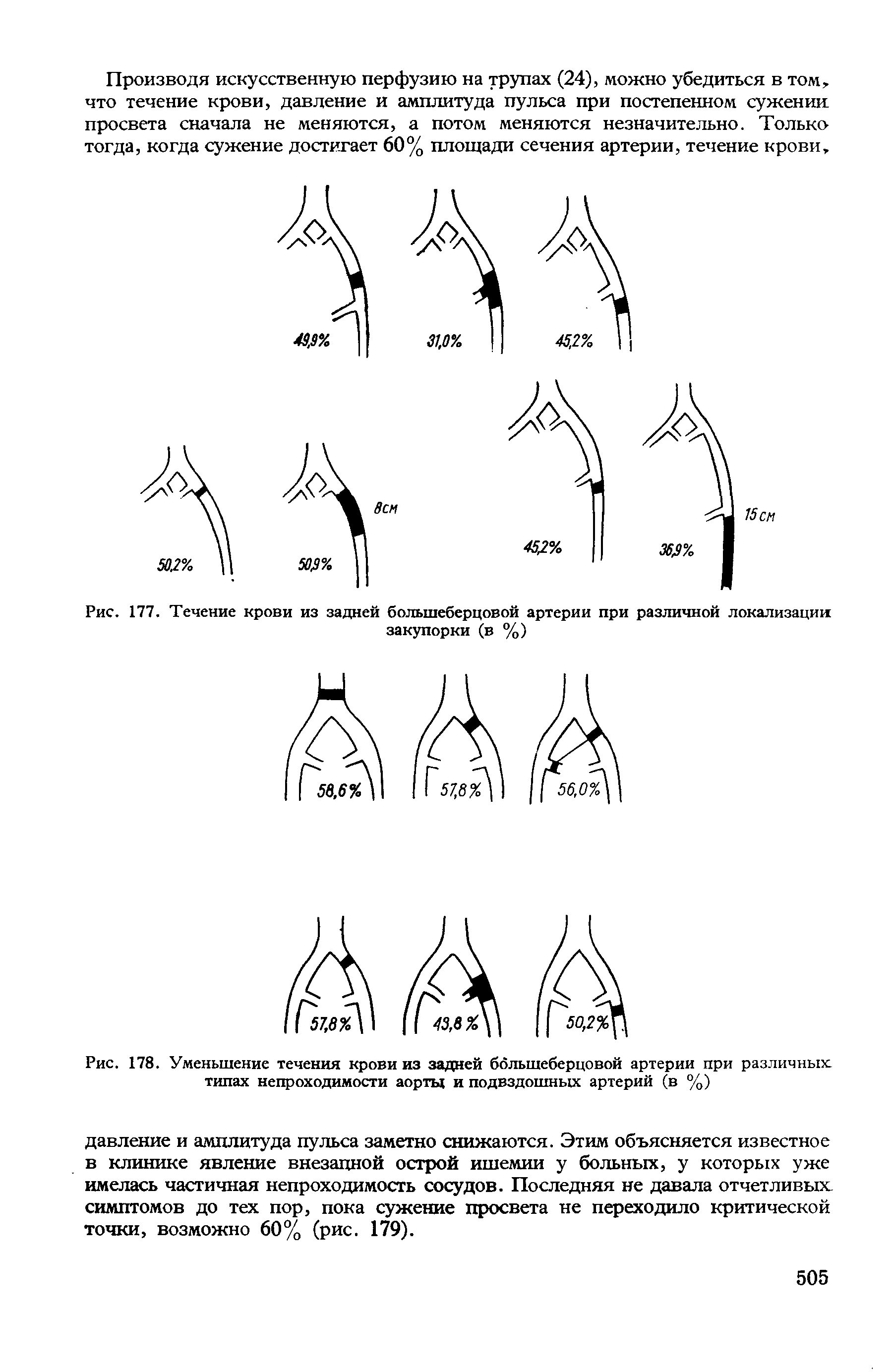 Рис. 178. Уменьшение течения крови из задней большеберцовой артерии при различных типах непроходимости аорты и подвздошных артерий (в %)...
