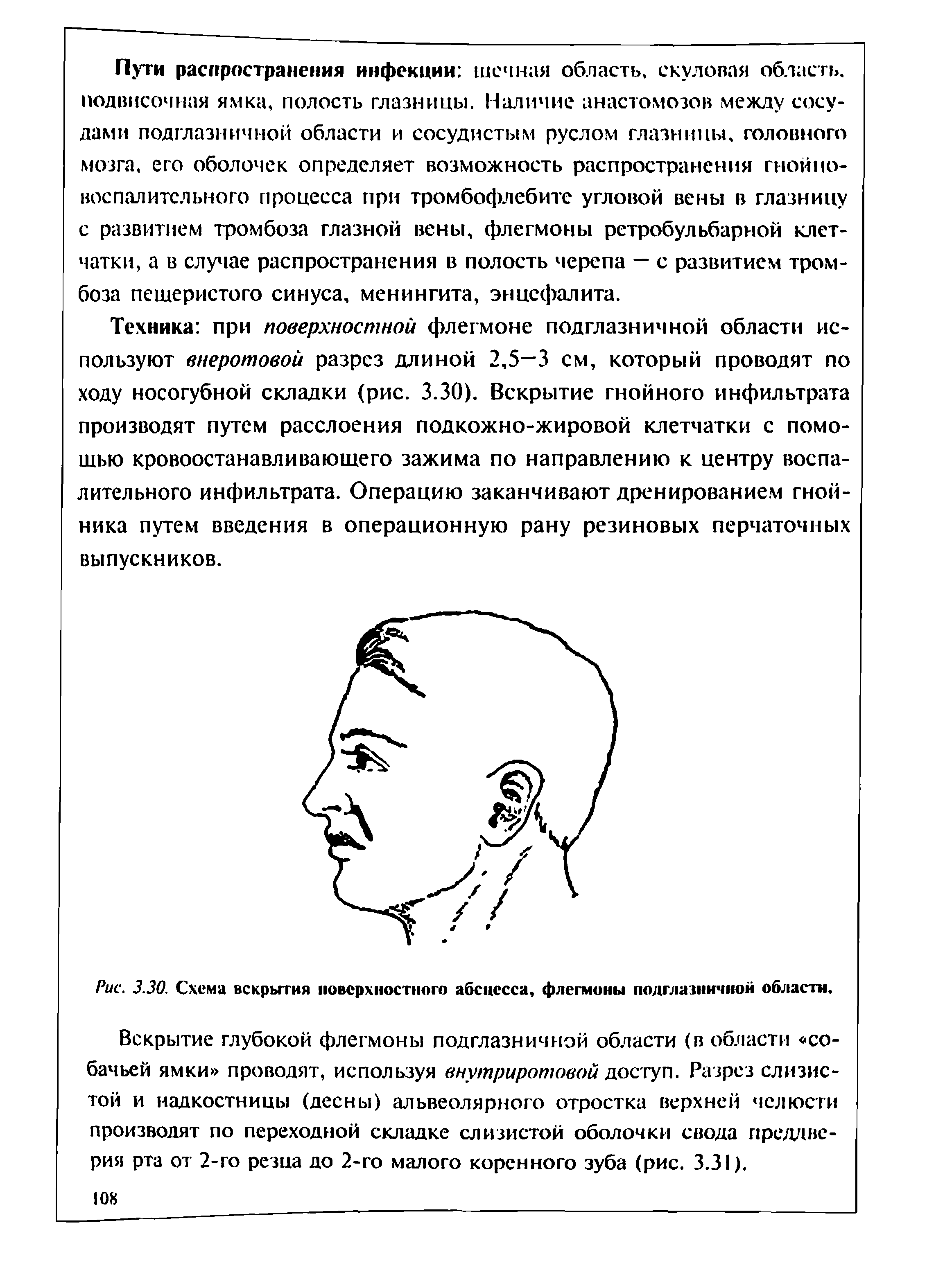 Рис. 3.30. Схема вскрытия поверхностного абсцесса, флегмоны подглазничной области.