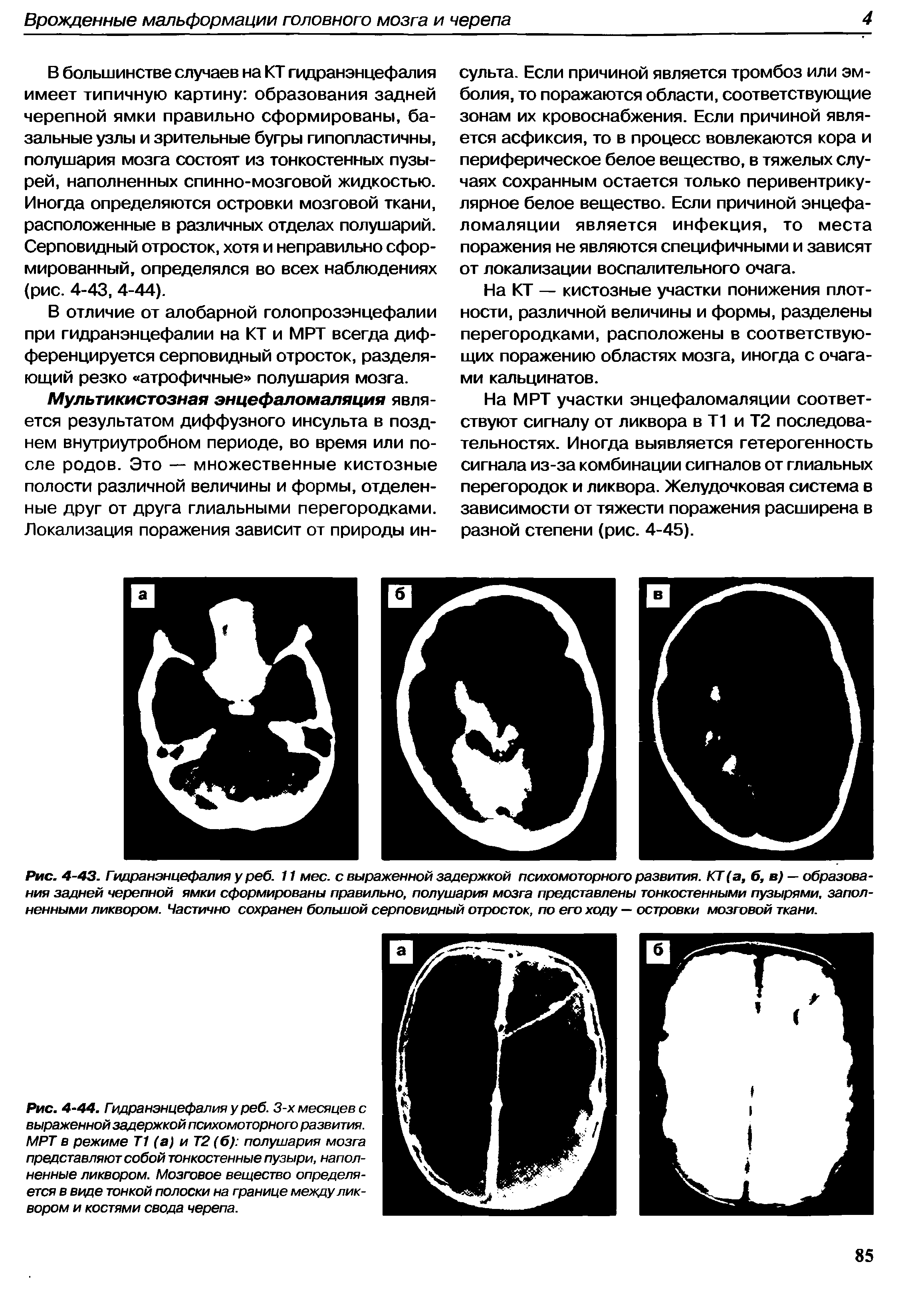 Рис. 4-43. Гидранэнцефалия у реб. 11 мес. с выраженной задержкой психомоторного развития. КГ (а, б, в) — образования задней черепной ямки сформированы правильно, полушария мозга представлены тонкостенными пузырями, заполненными ликвором. Частично сохранен большой серповидный отросток, по его ходу — островки мозговой ткани.