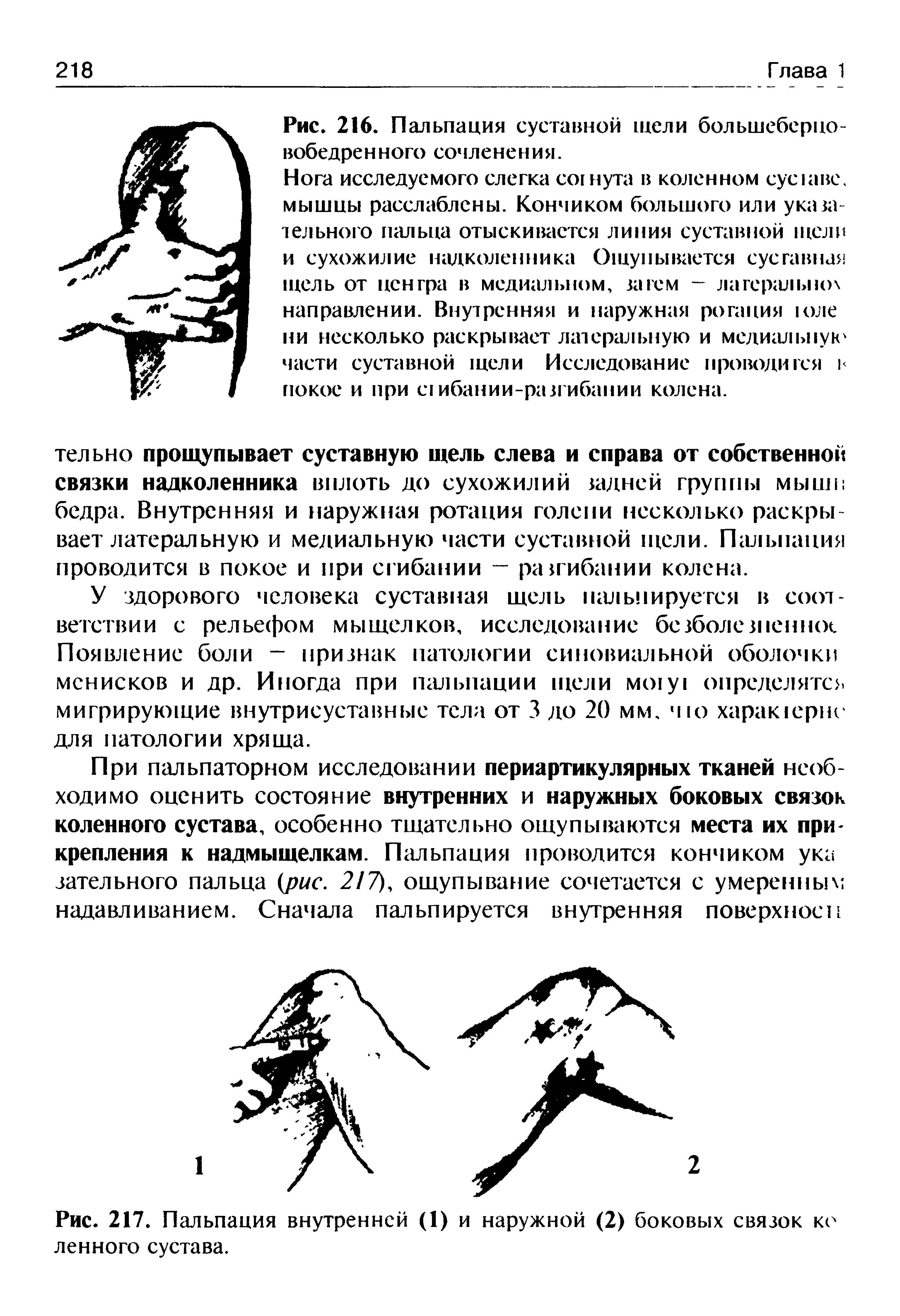 Рис. 217. Пальпация внутренней (1) и наружной (2) боковых связок ко ленного сустава.