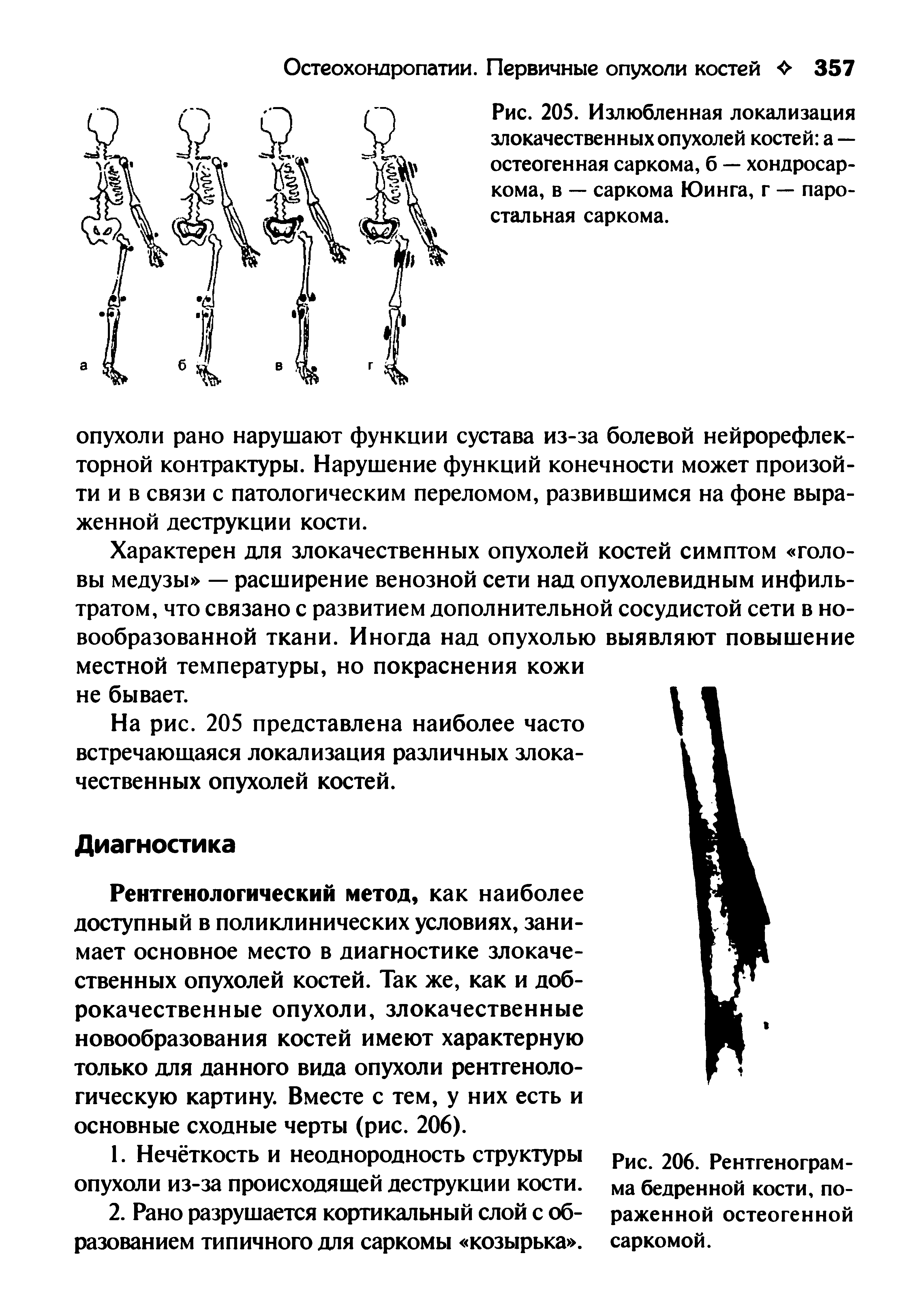 Рис. 205. Излюбленная локализация злокачественных опухолей костей а — остеогенная саркома, б — хондросаркома, в — саркома Юинга, г — паростальная саркома.