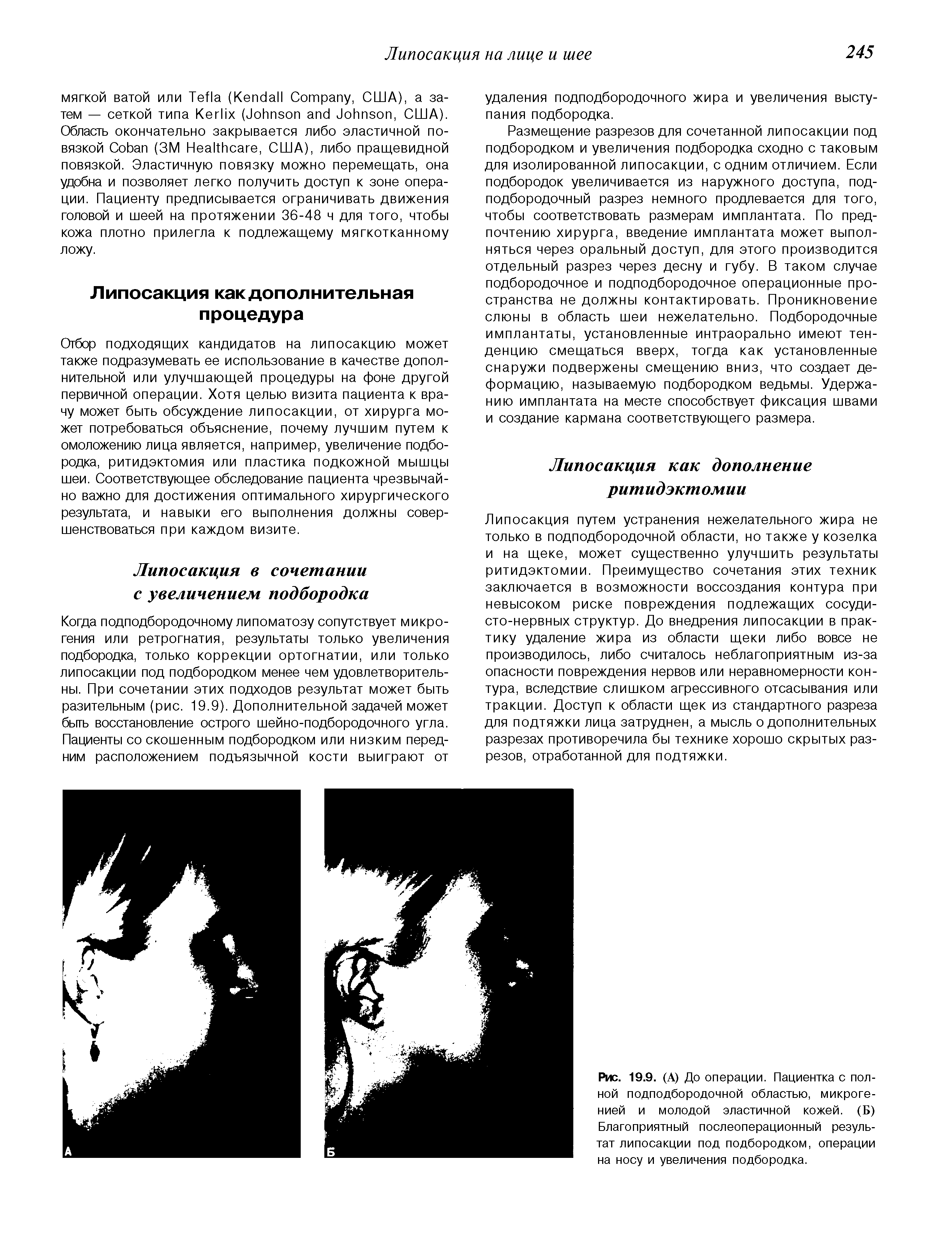 Рис. 19.9. (А) До операции. Пациентка с полной подподбородочной областью, микроге-нией и молодой эластичной кожей. (Б) Благоприятный послеоперационный результат липосакции под подбородком, операции на носу и увеличения подбородка.