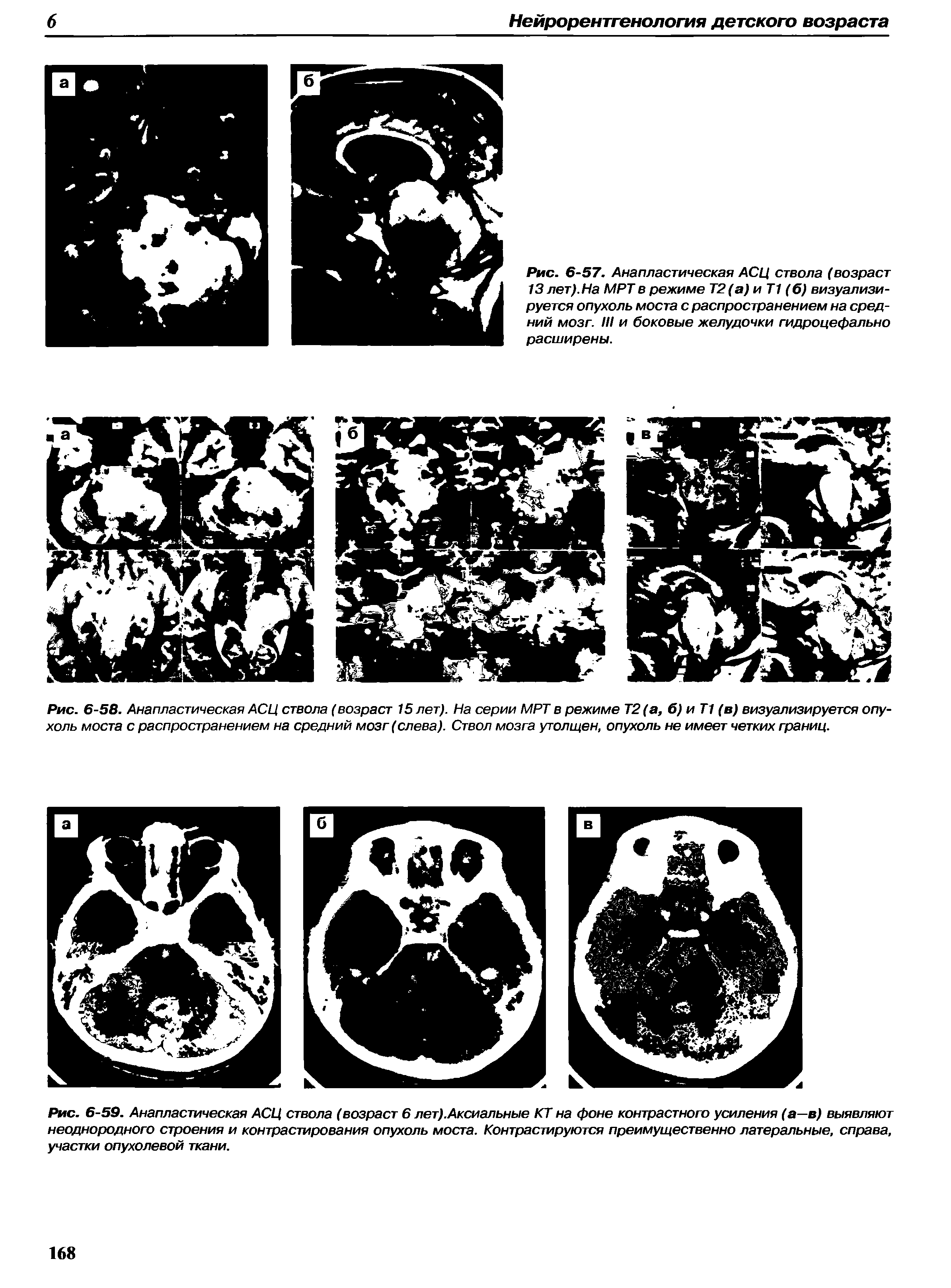 Рис. 6-59. Анапластическая АСЦ ствола (возраст 6 лет).Аксиальные КТ на фоне контрастного усиления (а—в) выявляют неоднородного строения и контрастирования опухоль моста. Контрастируются преимущественно латеральные, справа, участки опухолевой ткани.
