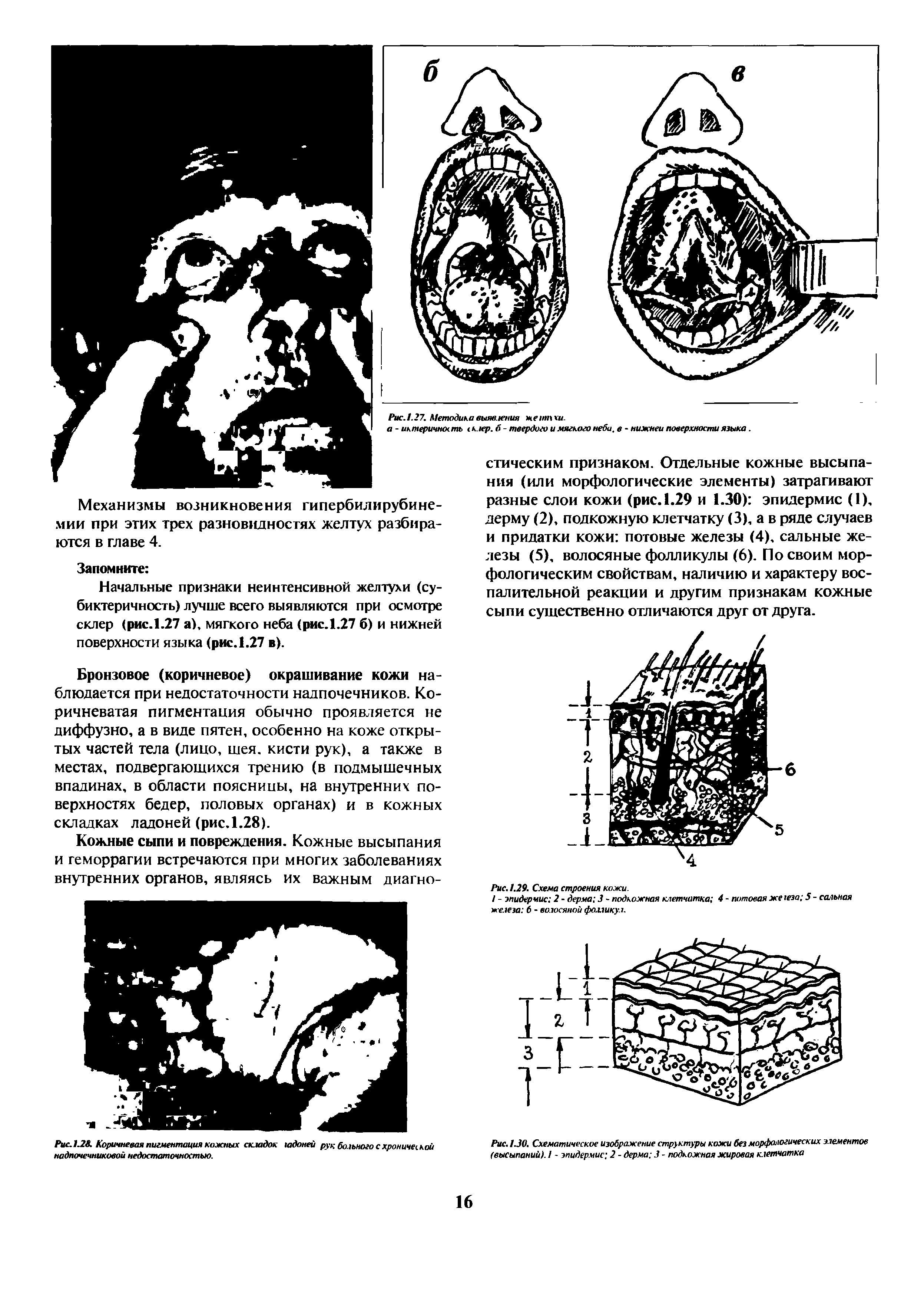 Рис.1.28. Коричневая пигментация кожных складок юдоней рук больного с хронической надпочечниковой недостаточностью.