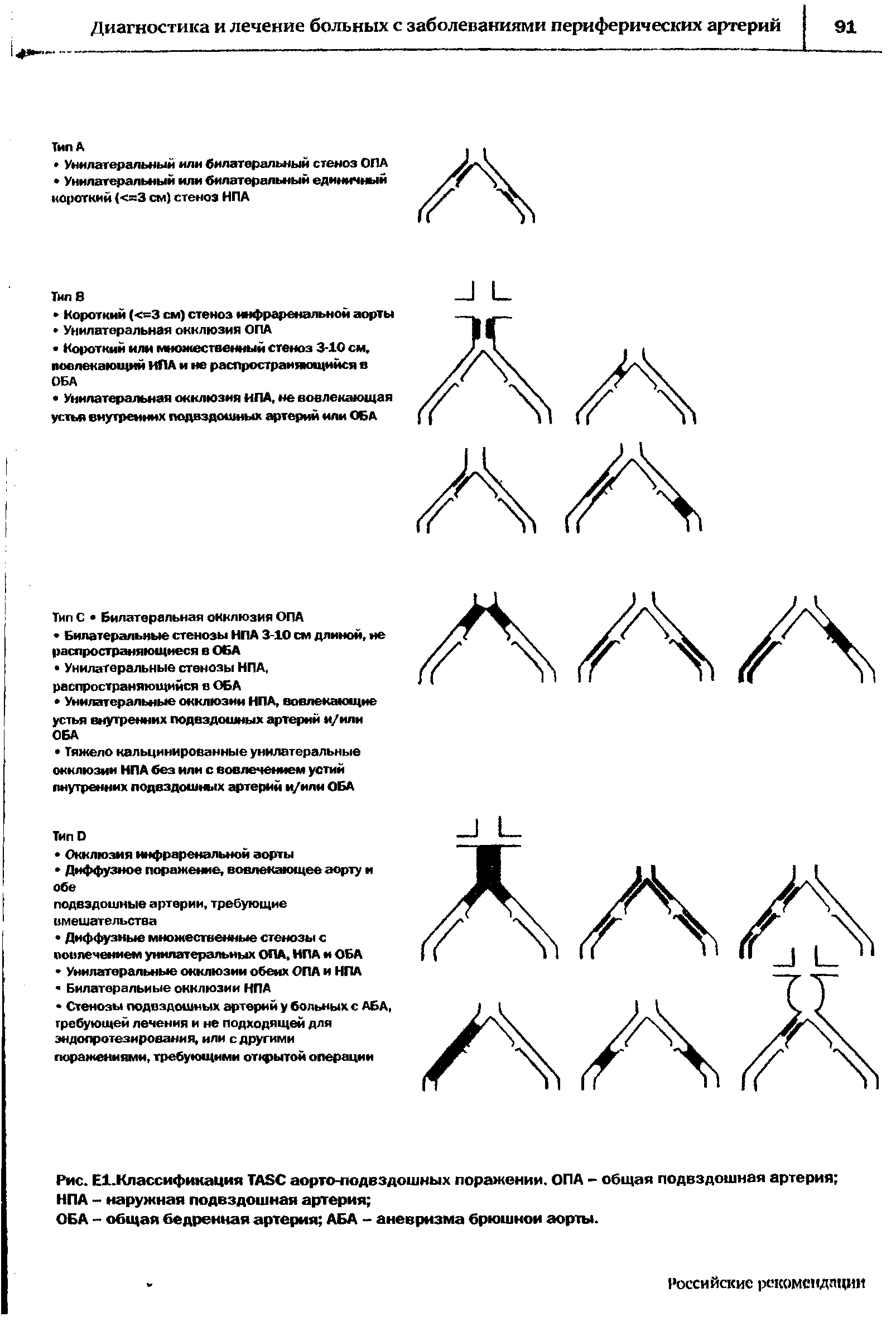 Рис. Е1.Классификация ТАБС аорто-лодвздошных поражении. ОПА - общая подвздошная артерия НПА - наружная подвздошная артерия ...