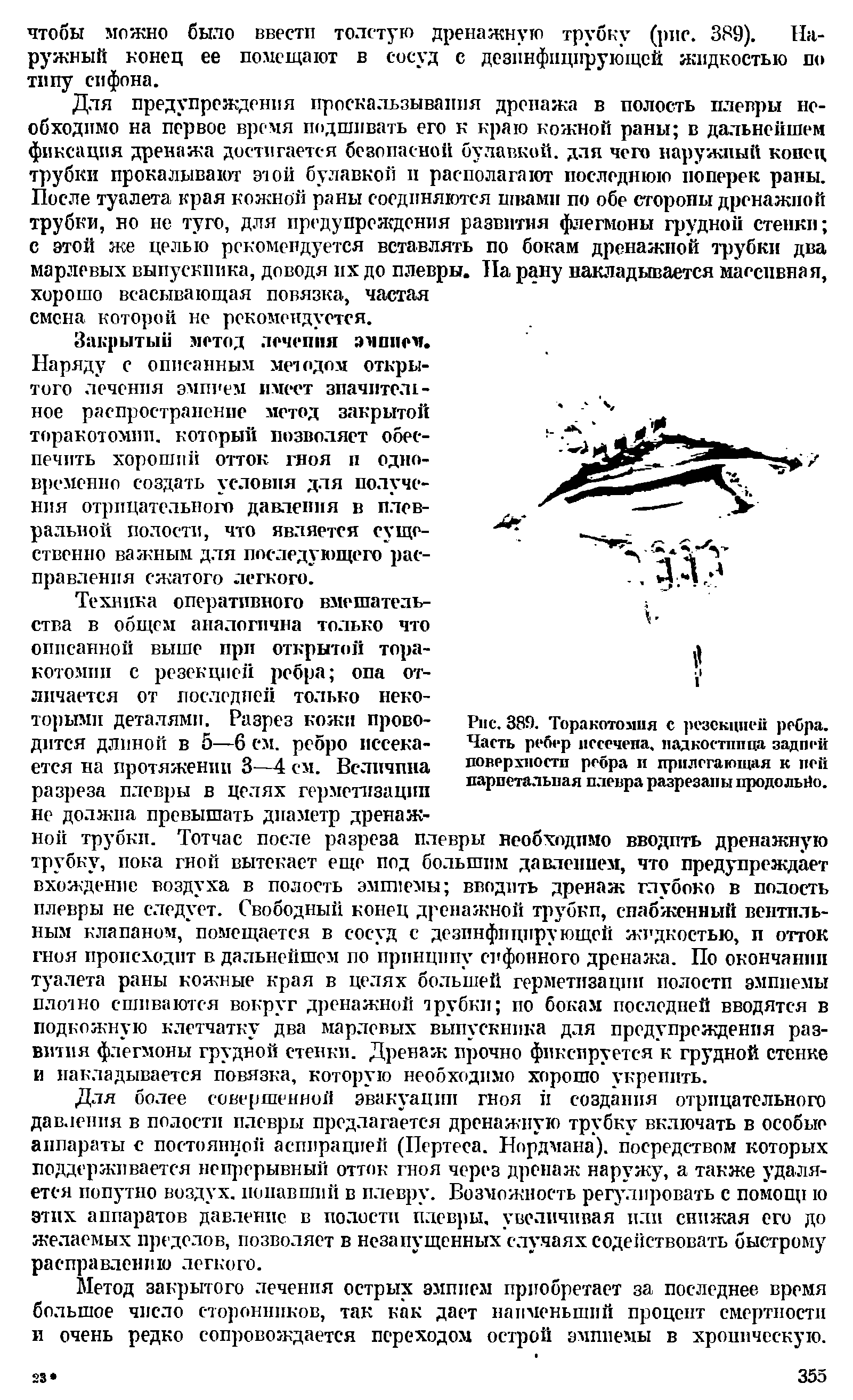 Рис. 389. Торакотомия с резекцией ребра. Часть ребер иссечепа, надкостница задней поверхности ребра и прилегающая к пей париетальная плевра разрезаны продольно.