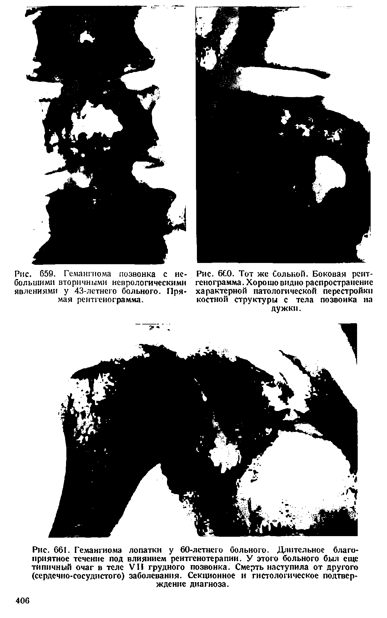 Рис. 661. Гемангиома лопатки у 60-летнего больного. Длительное благоприятное течение под влиянием рентгенотерапии. У этого больного был еще типичный очаг в теле VII грудного позвонка. Смерть наступила от другого (сердечно-сосудистого) заболевания. Секционное и гистологическое подтверждение диагноза.