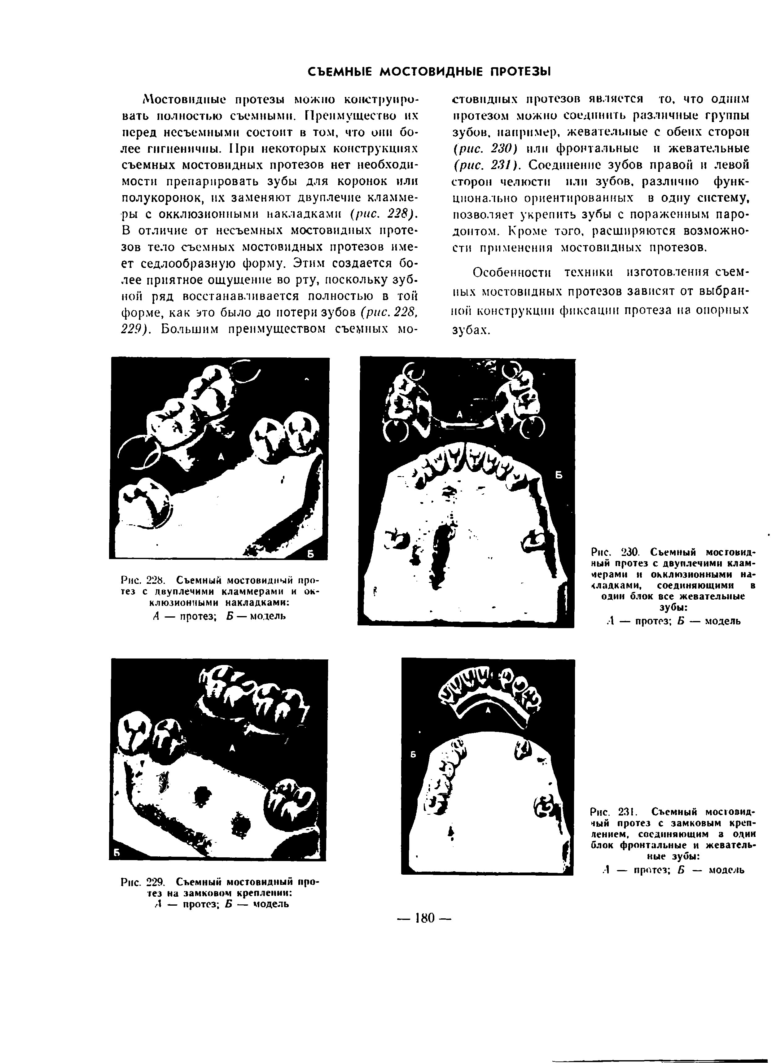 Рис. 231. Съемный мосювид-чый протез с замковым креплением, соединяющим а один блок фронтальные и жевательные зубы ...