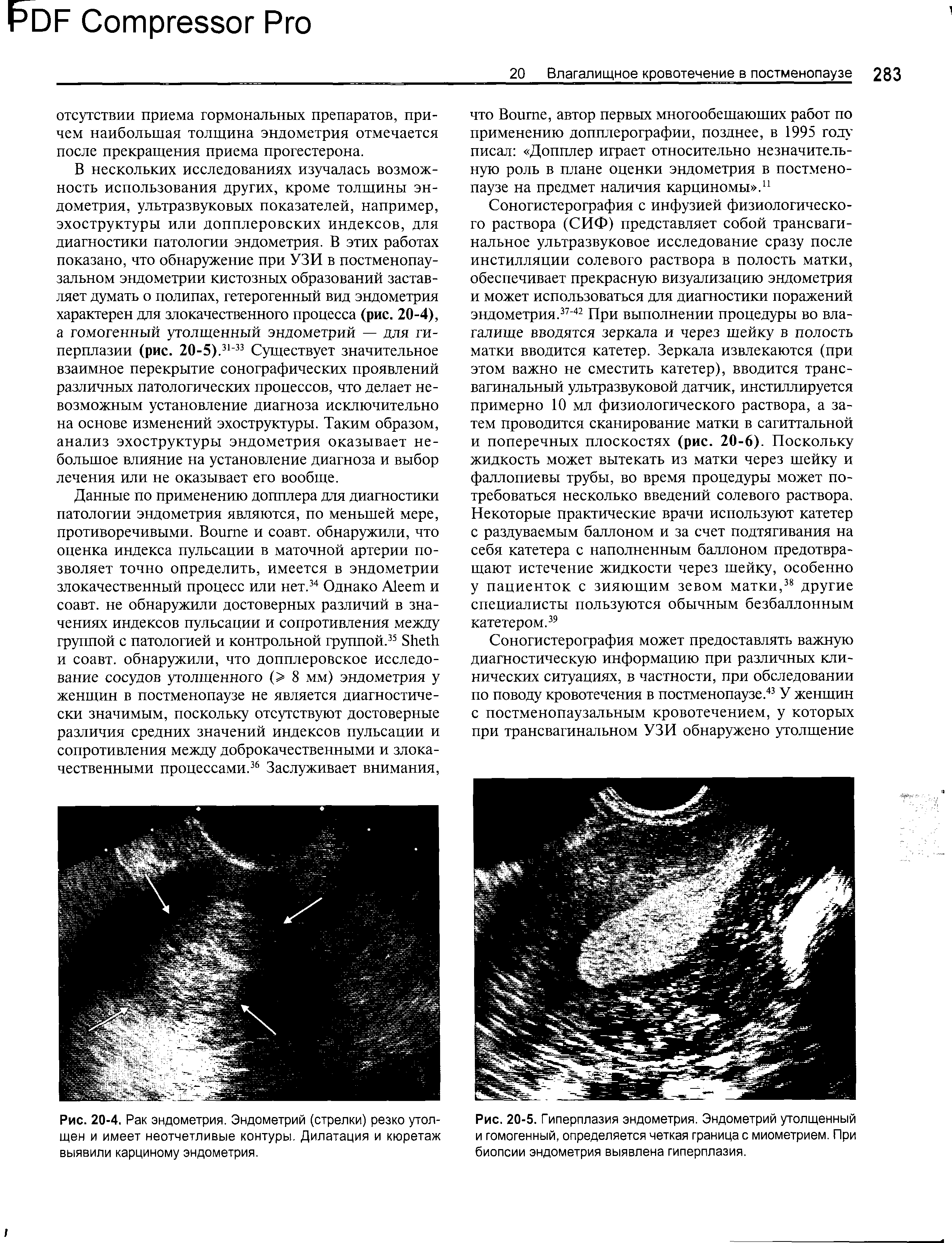 Рис. 20-4. Рак эндометрия. Эндометрий (стрелки) резко утолщен и имеет неотчетливые контуры. Дилатация и кюретаж выявили карциному эндометрия.