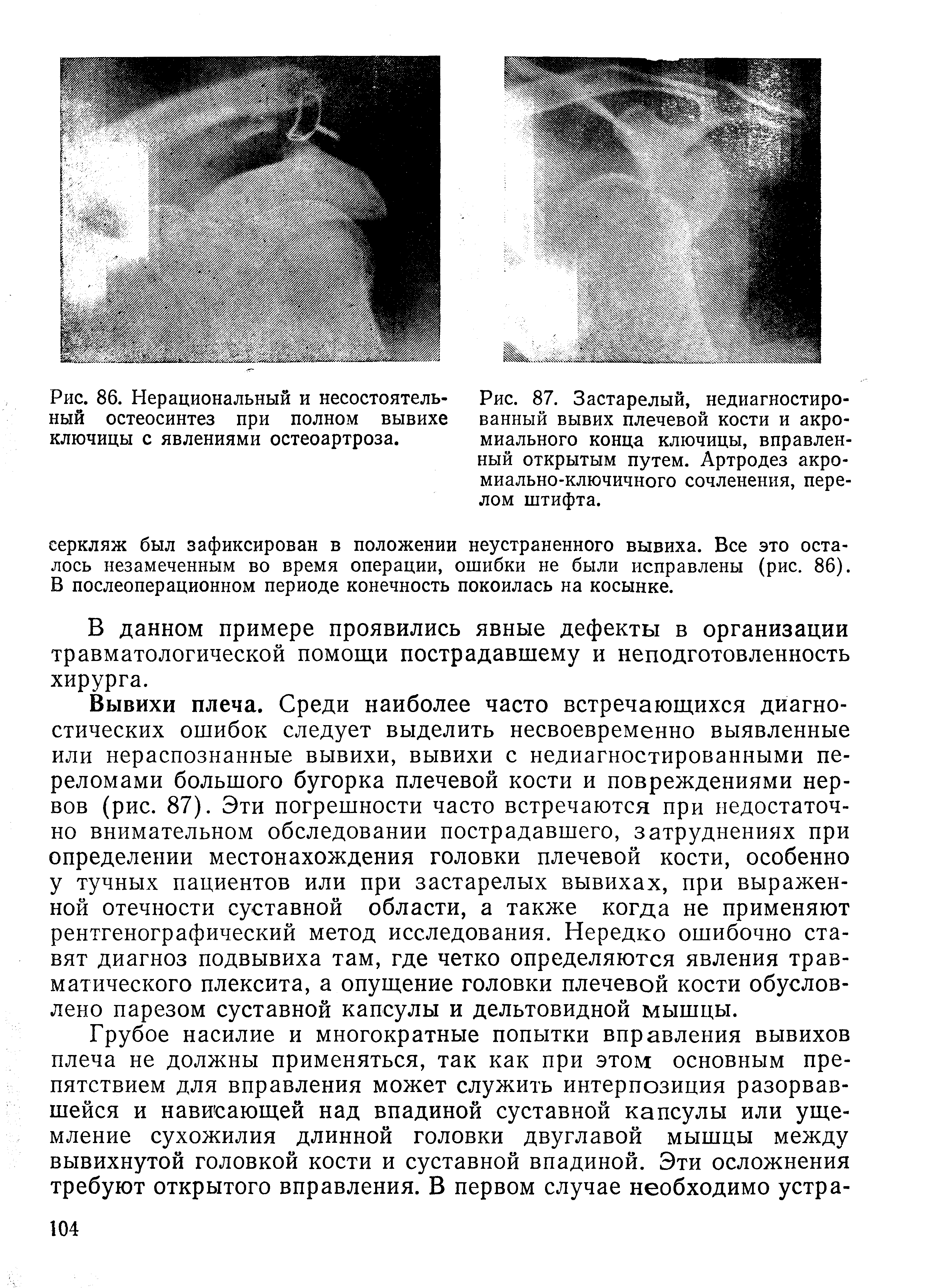 Рис. 87. Застарелый, недиагностиро-ванный вывих плечевой кости и акромиального конца ключицы, вправленный открытым путем. Артродез акромиально-ключичного сочленения, перелом штифта.